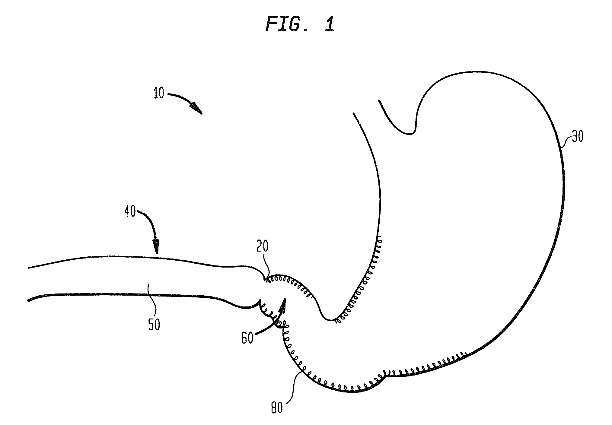 Systems and methods for treatment of obesity and type 2 diabetes