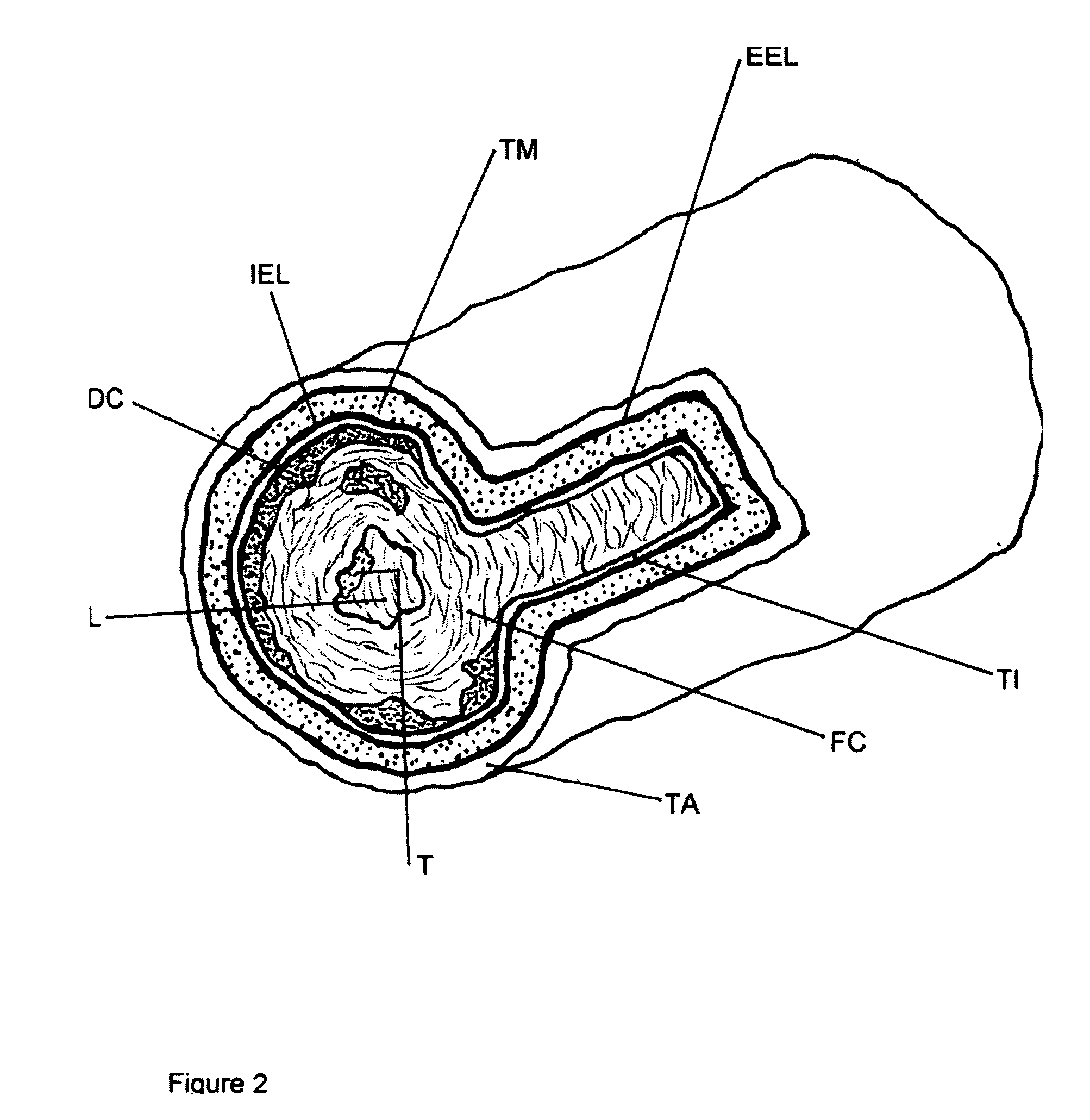 Forward-directed atherectomy catheter