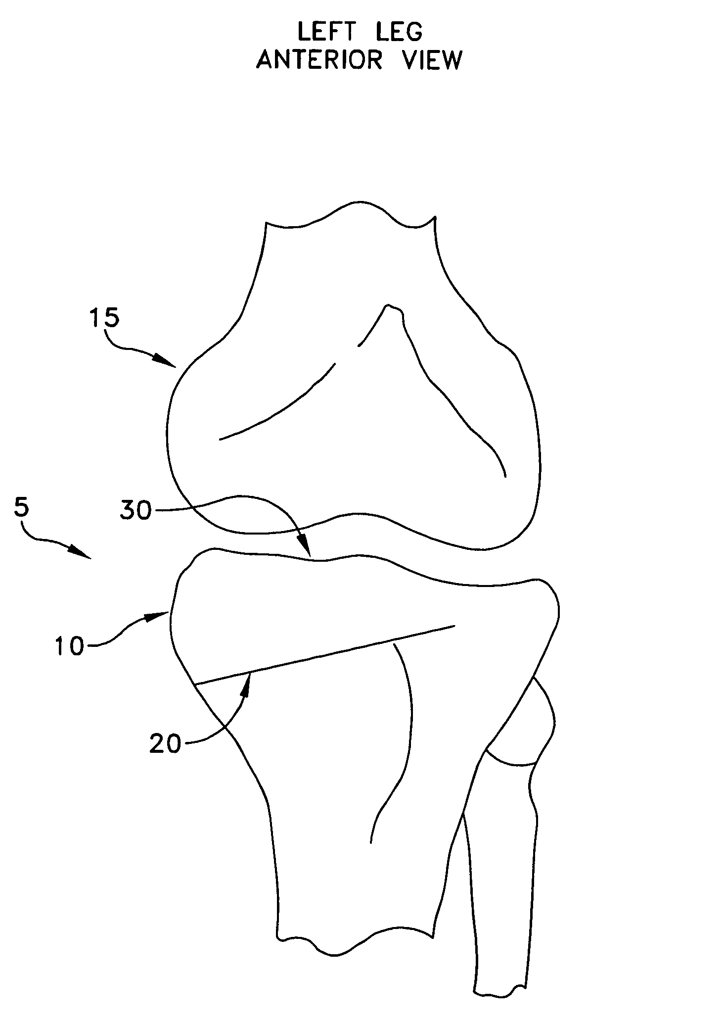 Method and apparatus for performing an open wedge, high tibial osteotomy