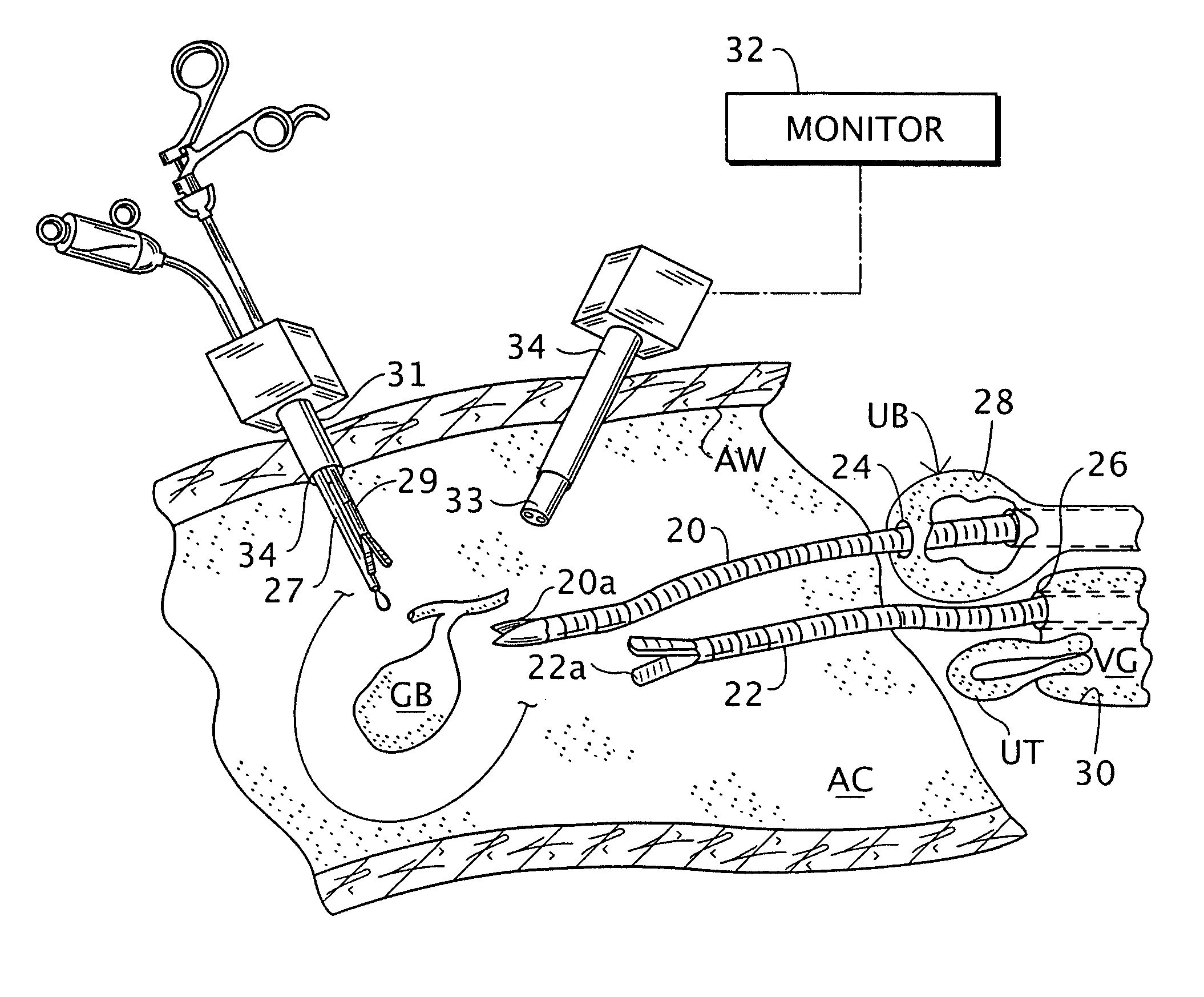 Intra-abdominal medical procedures and device