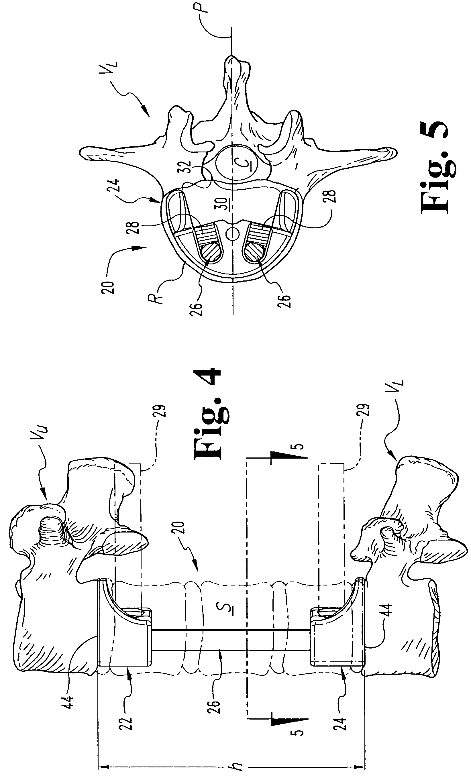 Apparatus and method for supporting vertebral bodies