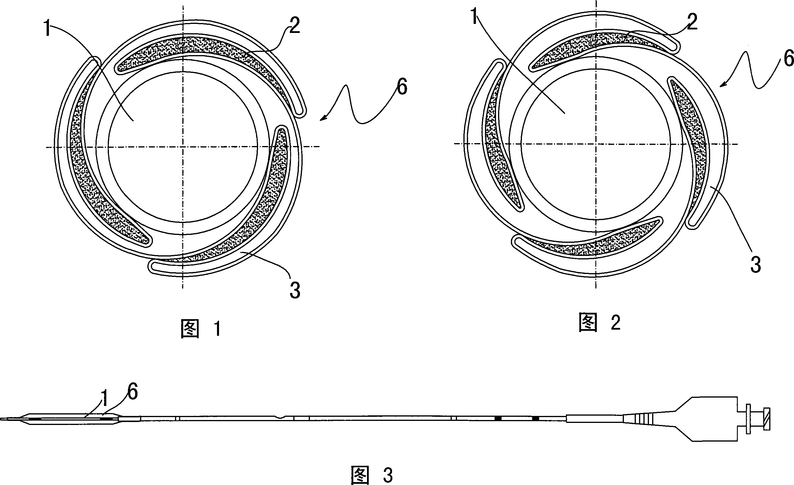 Novel sacculus dilating catheter