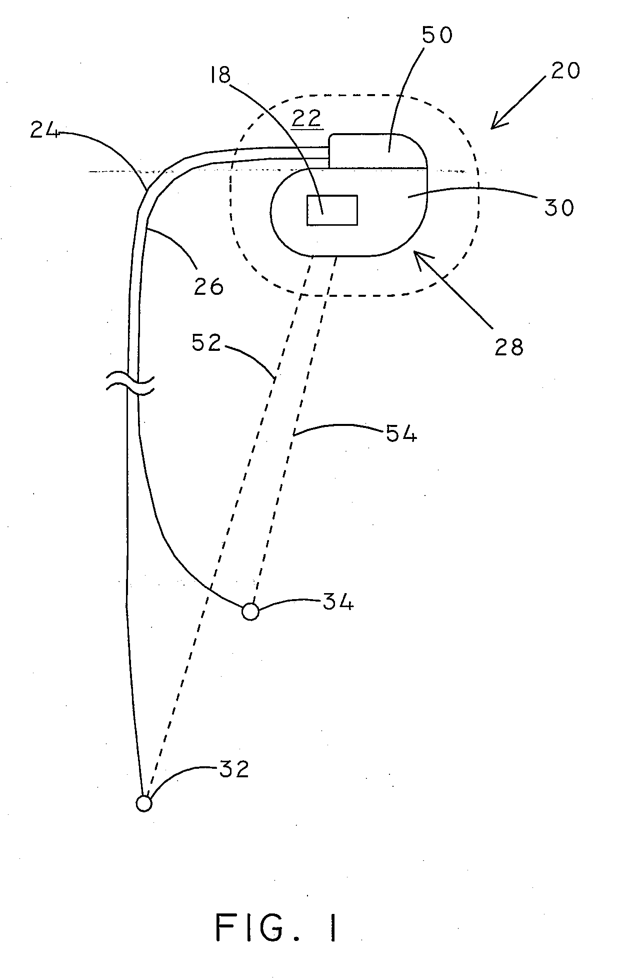 Implantable Medical Device and Methods for Automated Detection of Infection