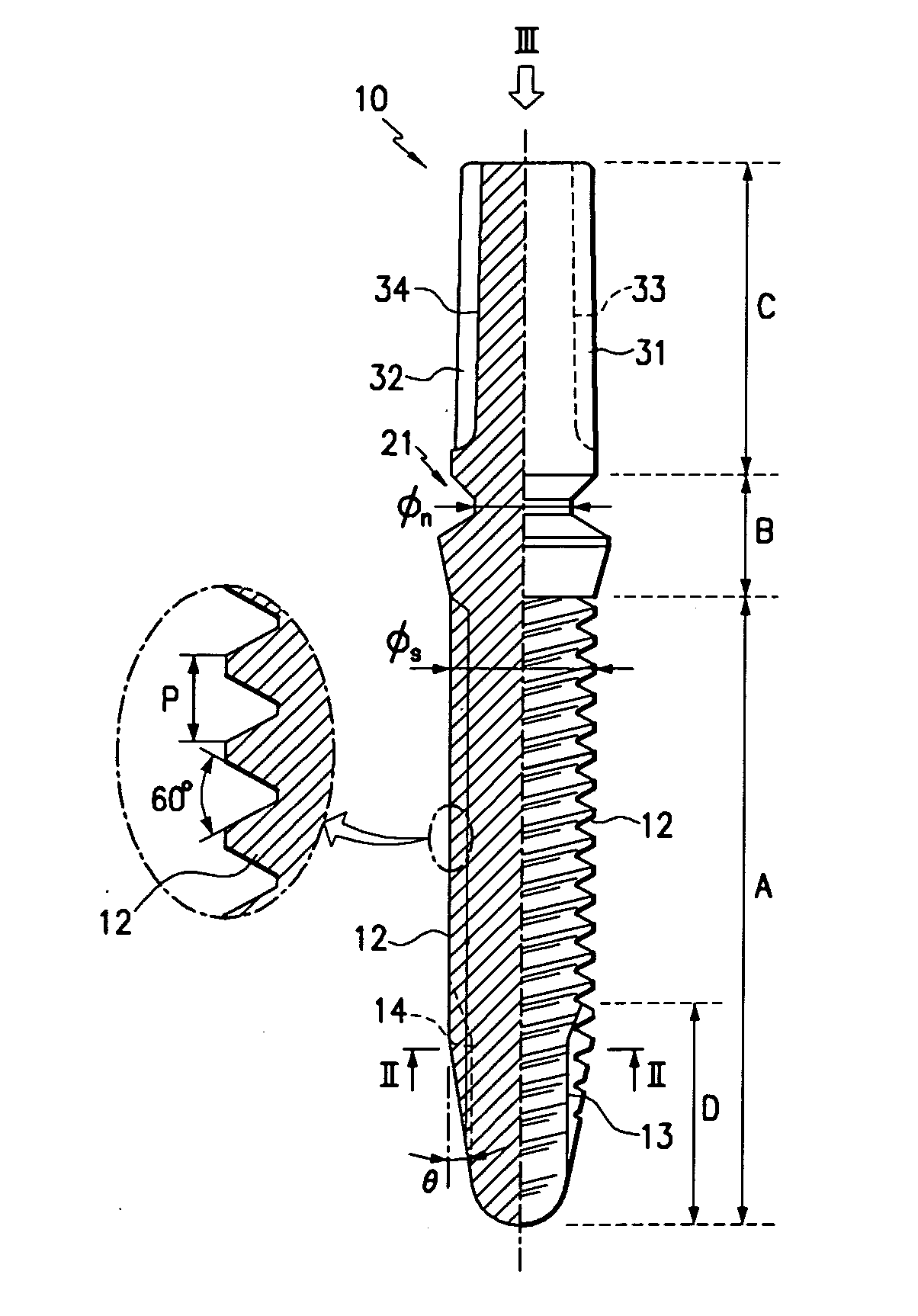 Dental implant