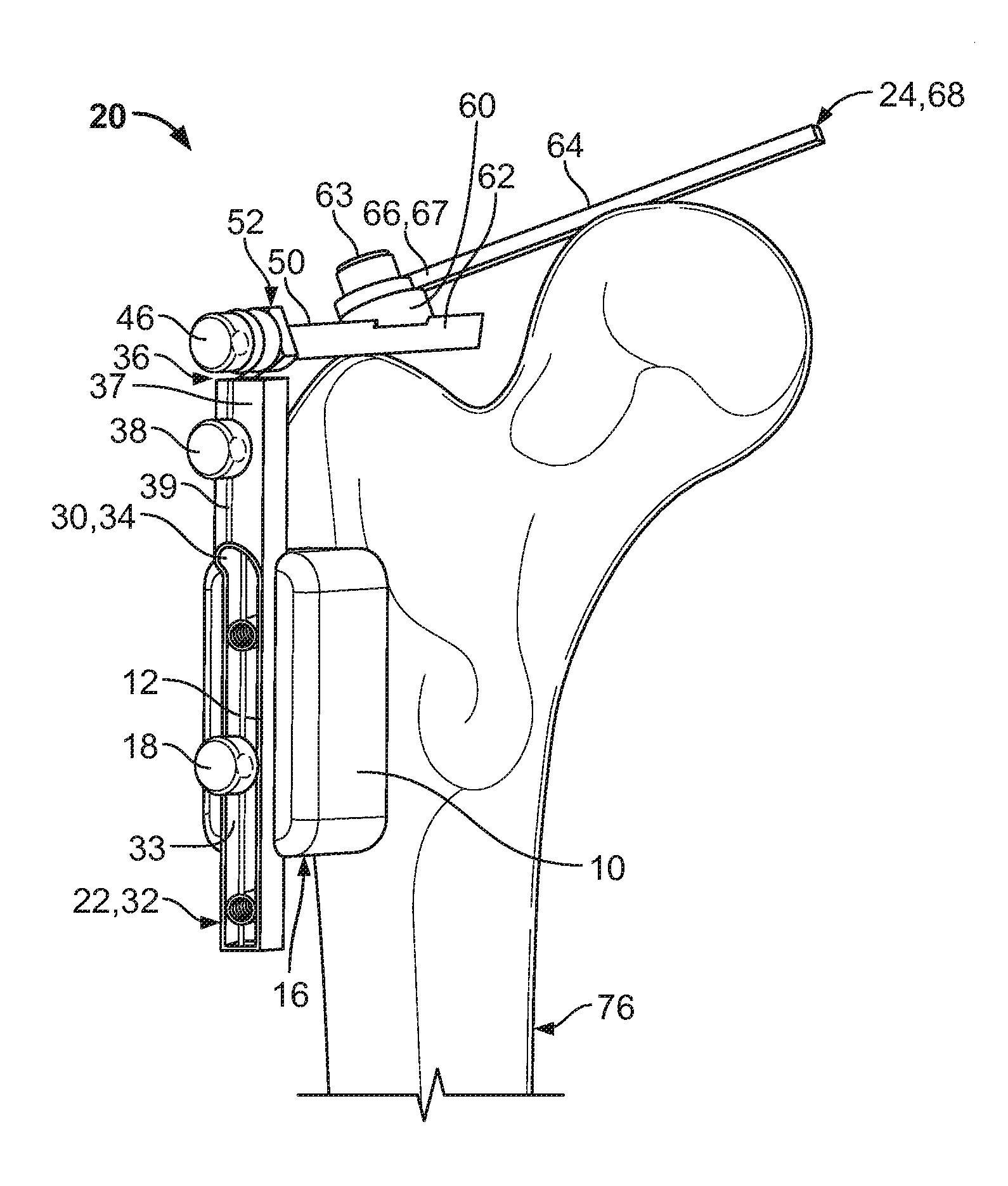 Native version alignment devices and methods