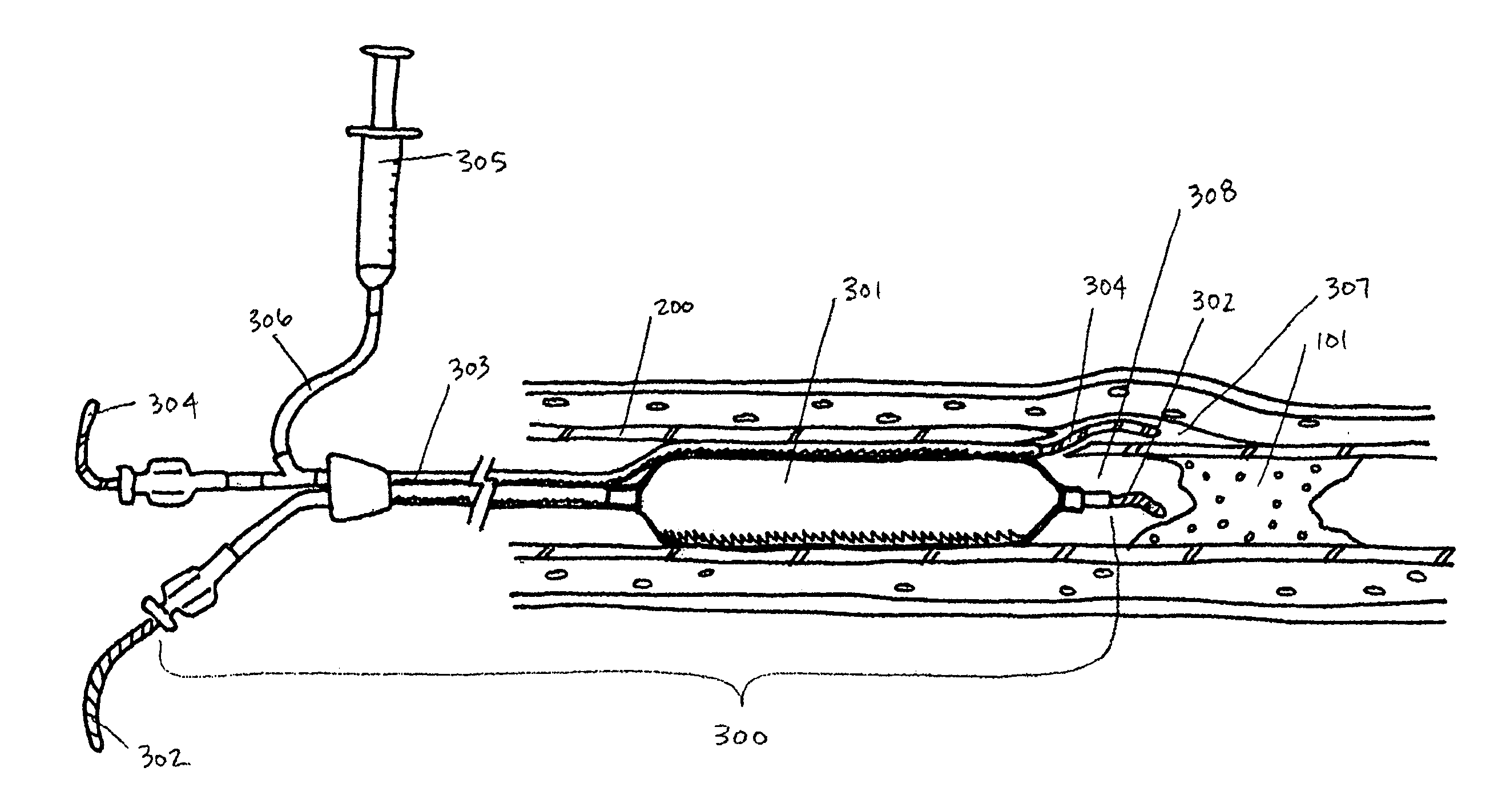 Endovascular devices and methods