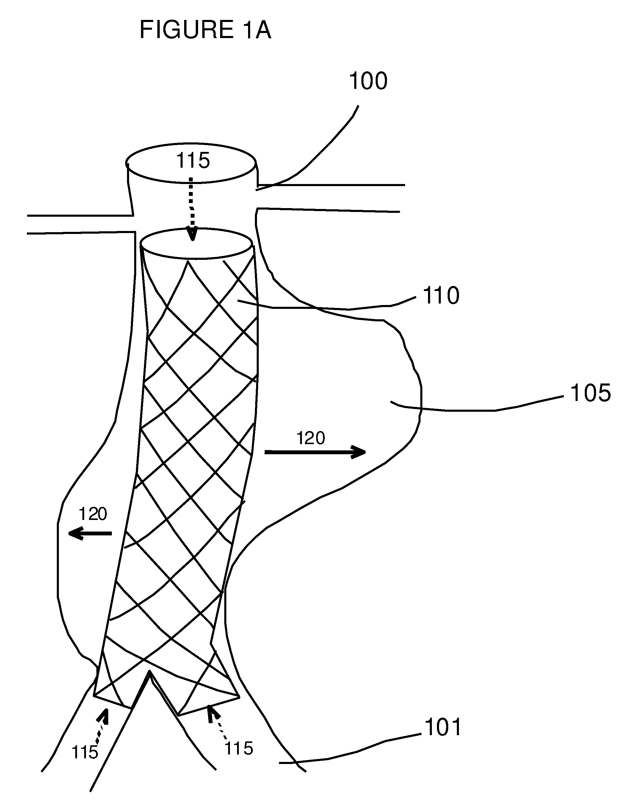 Prevention of displacement of prosthetic devices within aneurysms