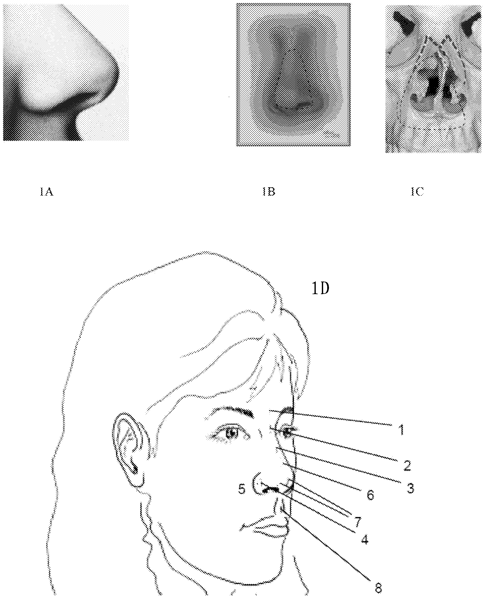 Treatment of nasal and sinus disorders