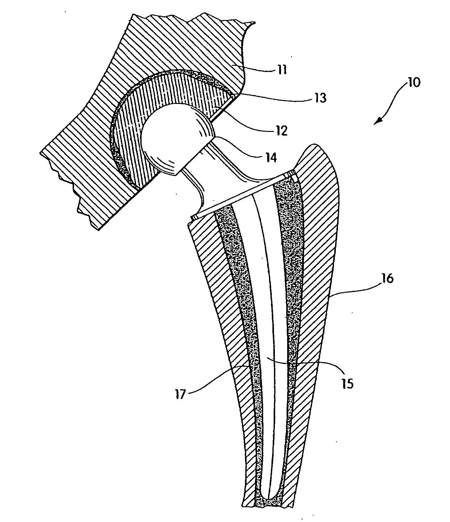 Radiation and melt treated ultra high molecular weight polyethylene prosthetic devices