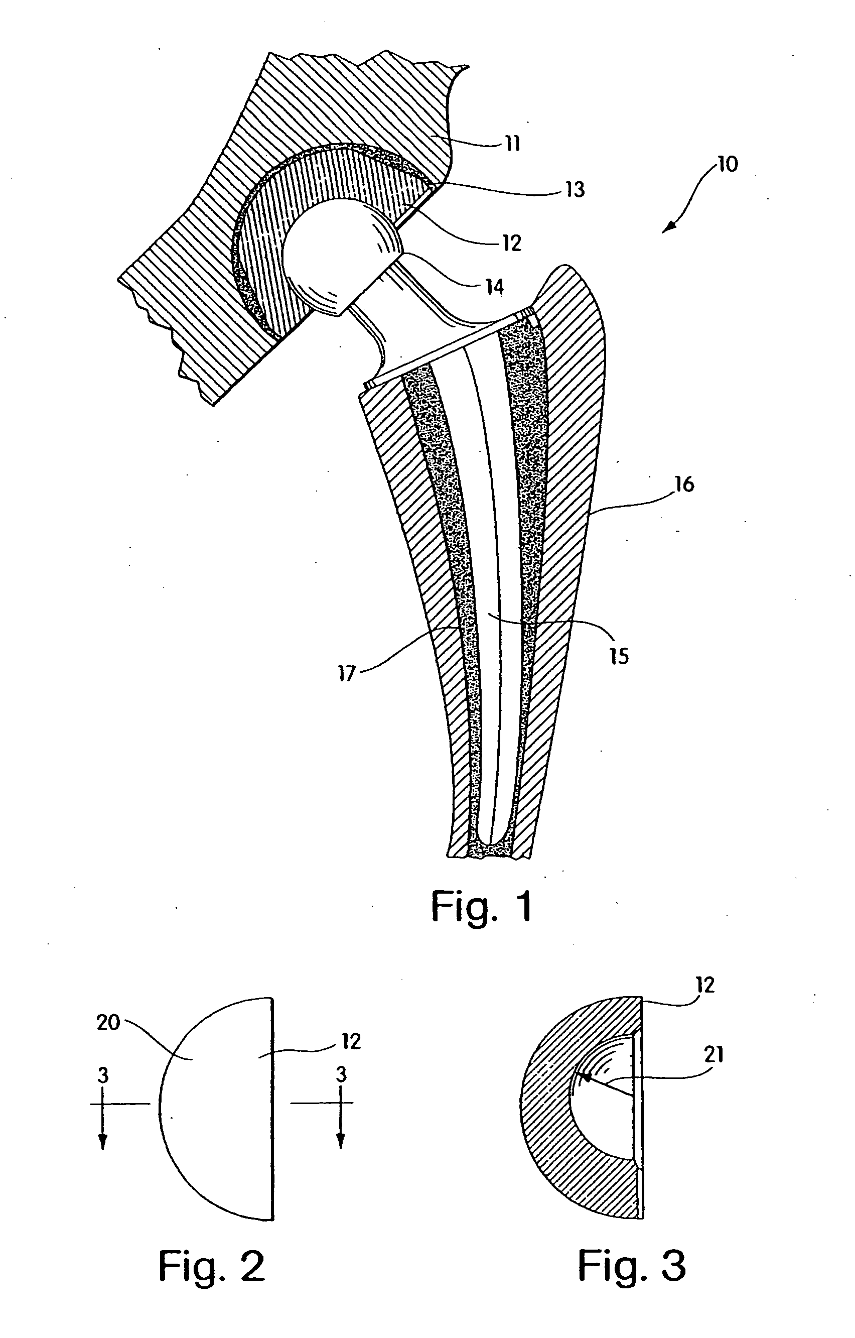 Radiation and melt treated ultra high molecular weight polyethylene prosthetic devices