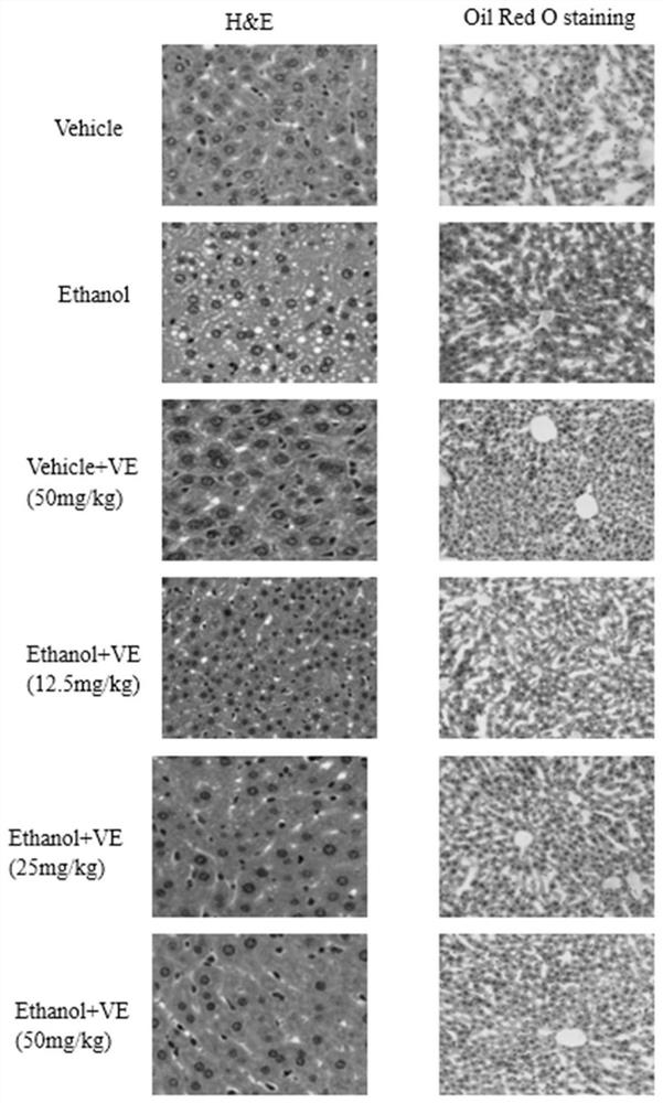 Application of verbenin in medicine for treating alcoholic liver injury