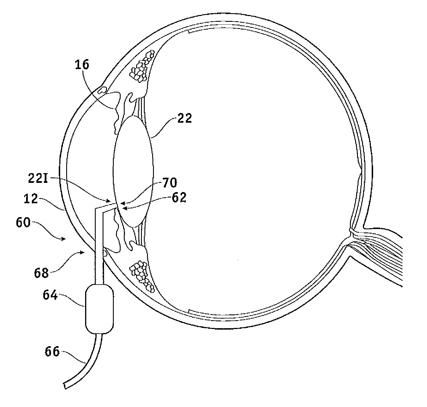 Capsular membrane treatments to increase accommodative amplitude