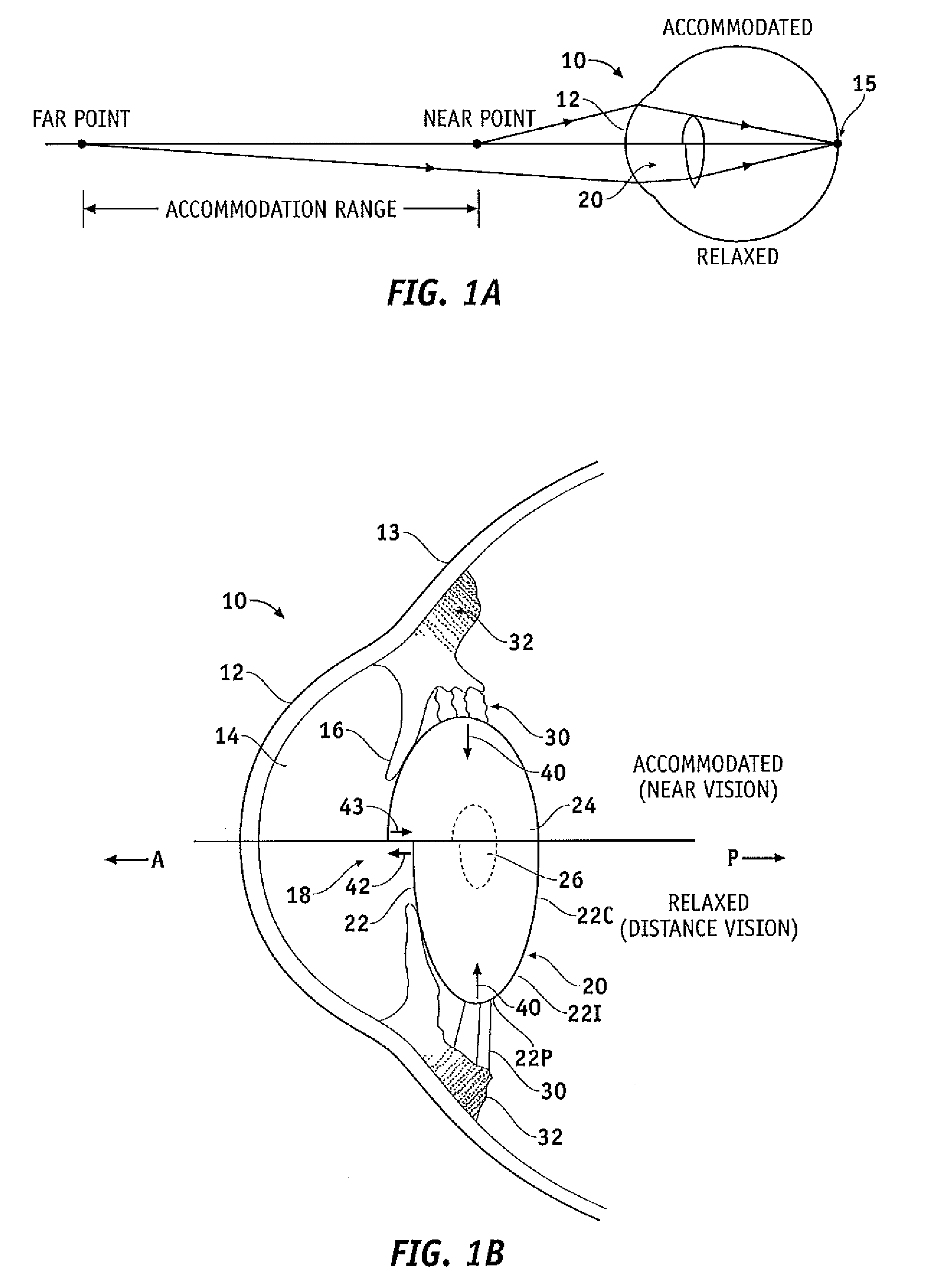 Capsular membrane treatments to increase accommodative amplitude