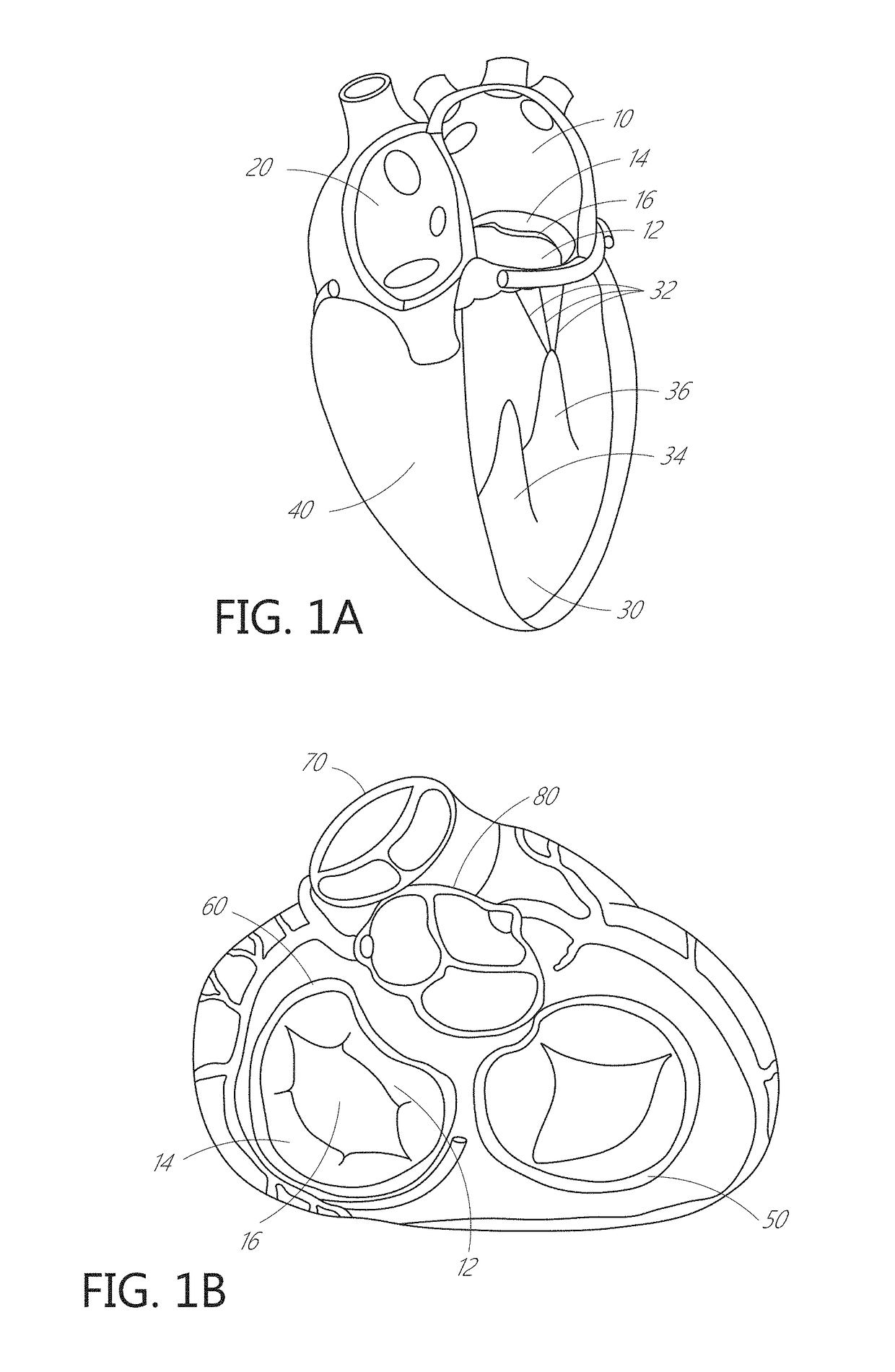 Device, system, and method for transcatheter treatment of valvular regurgitation