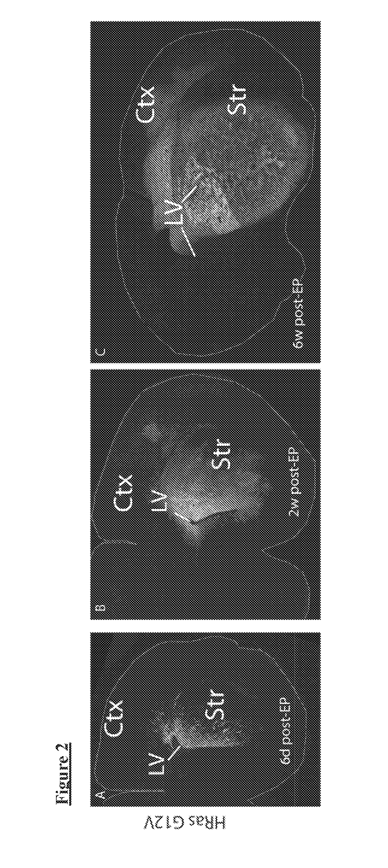 Ets factors regulate neural stem cell depletion and gliogenesis in ras pathway glioma