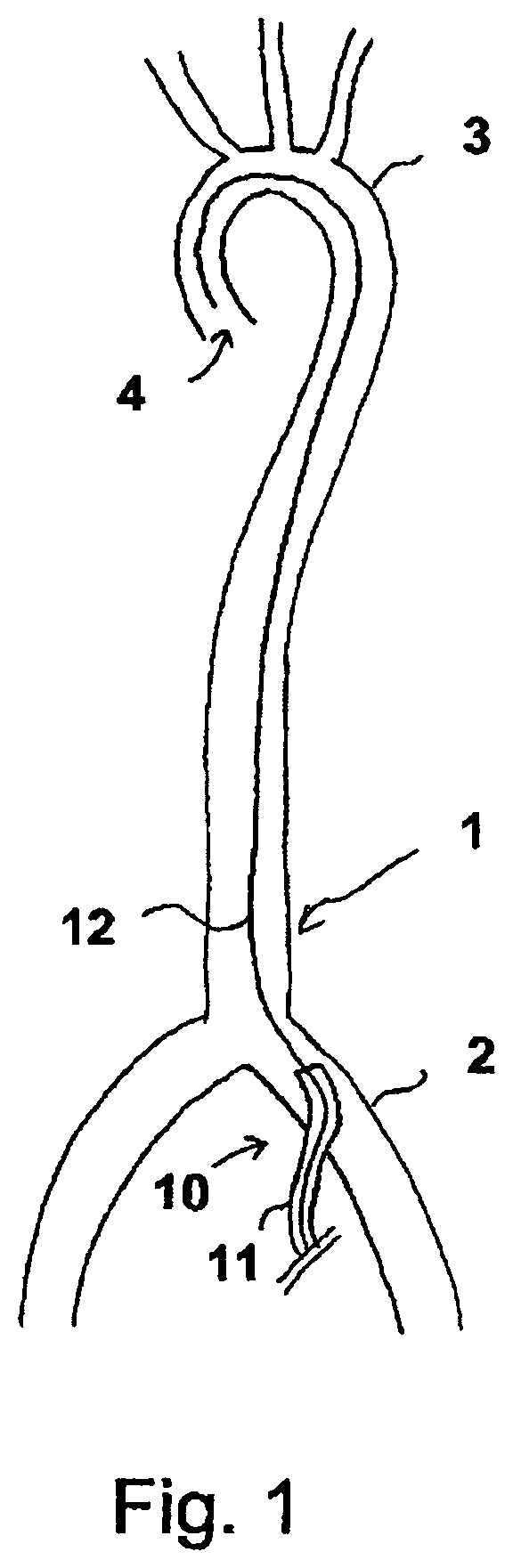 Sheath device for inserting a catheter