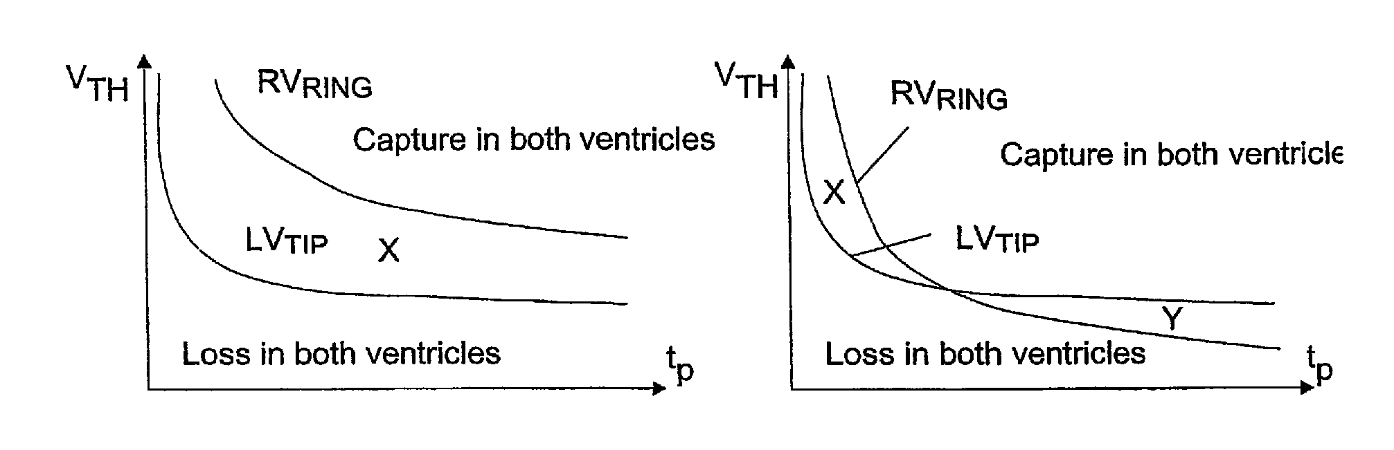 Implantable heart stimulation device with remedial response to anodal capture