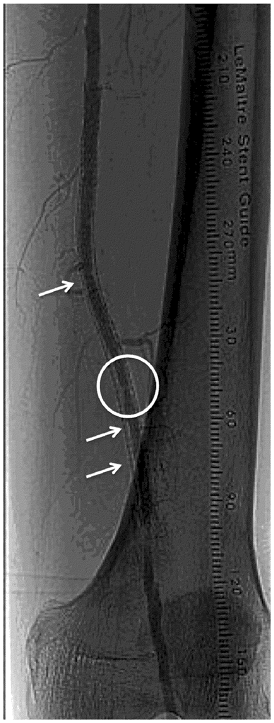 Device and method for treating in-stent restenosis