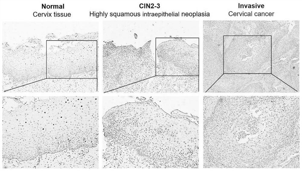 Application of TOP1 as cervical cancer marker and/or therapeutic target