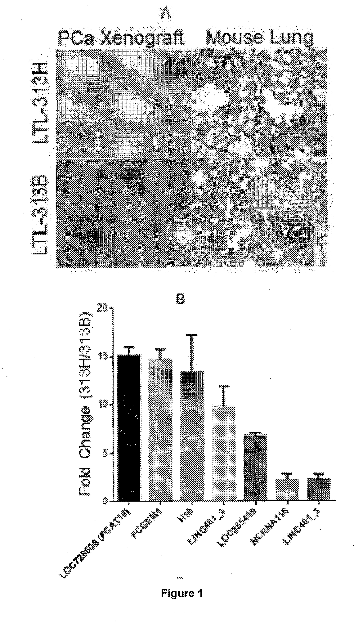 Methods and uses for diagnosis and treatment of prostate cancer