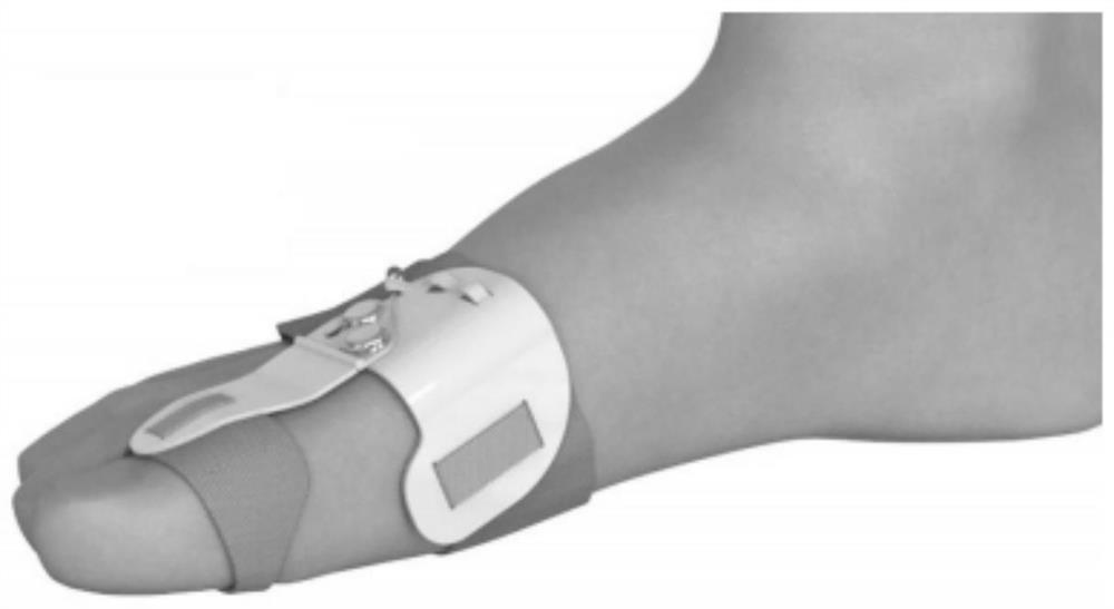 Rigid-flexible coupled orthosis for hallux valgus deformity