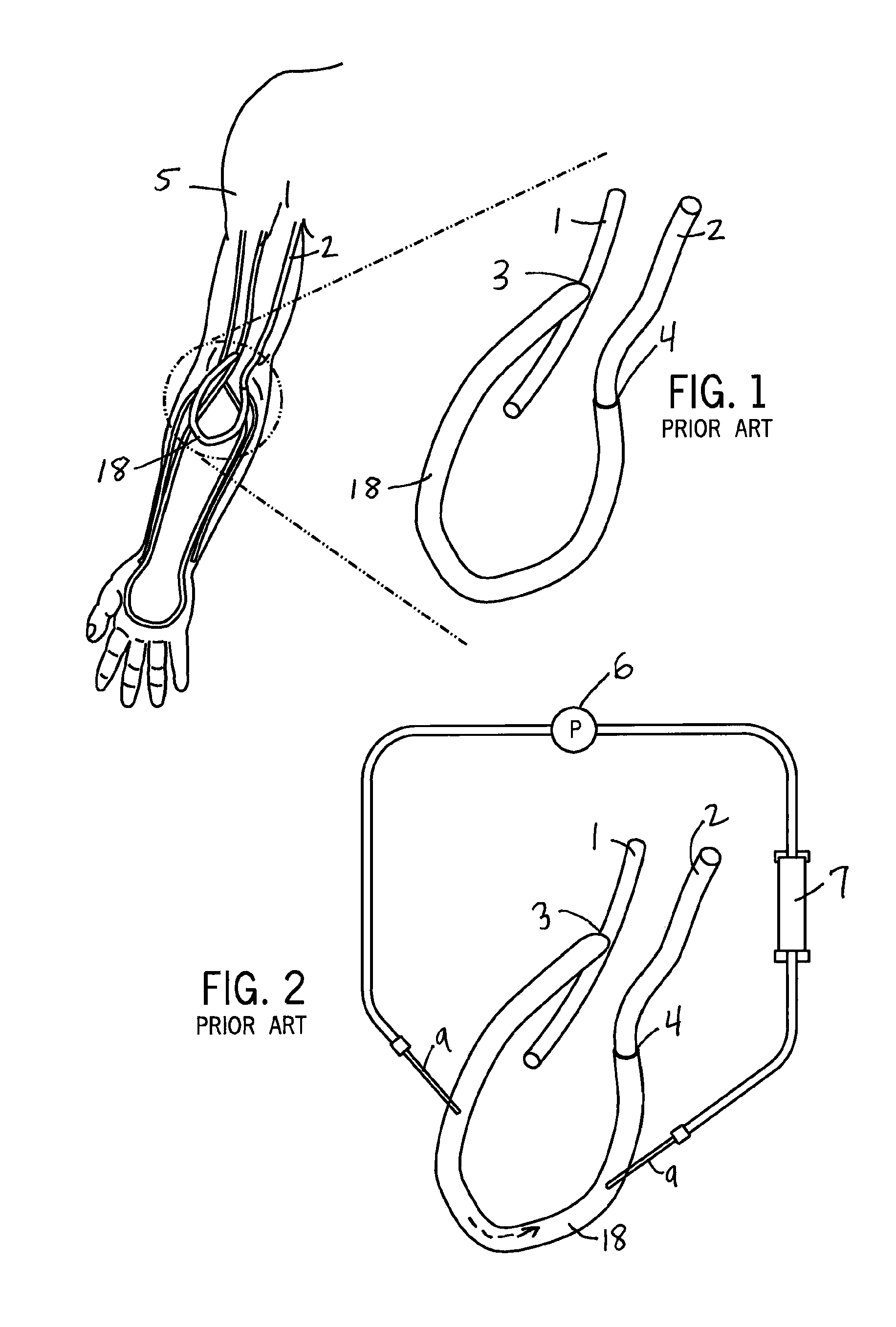 Hemodialysis arterio-venous graft with a ring-like diameter-adjustable device