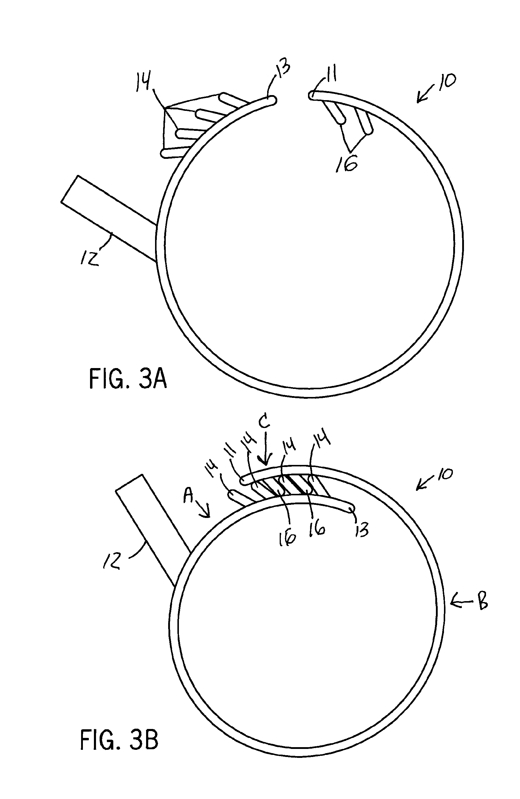 Hemodialysis arterio-venous graft with a ring-like diameter-adjustable device