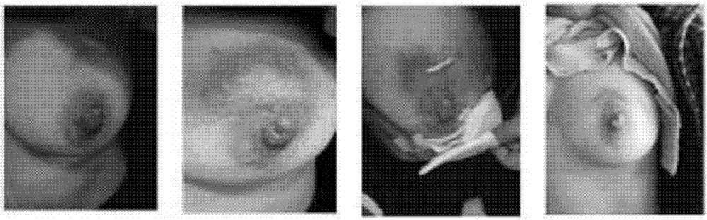 Compound traditional Chinese medicine for treating non-lactation mastitis