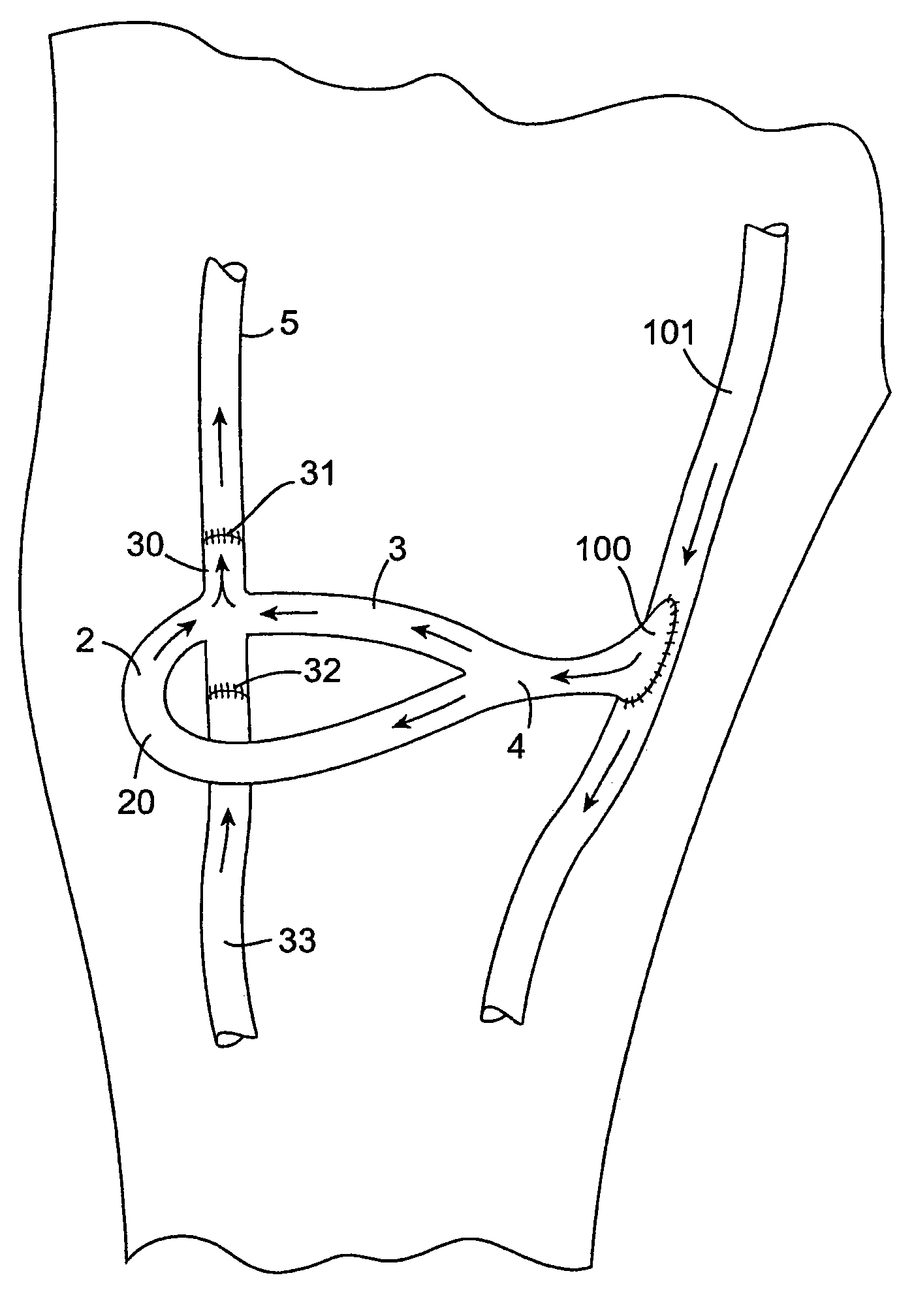 Vascular graft