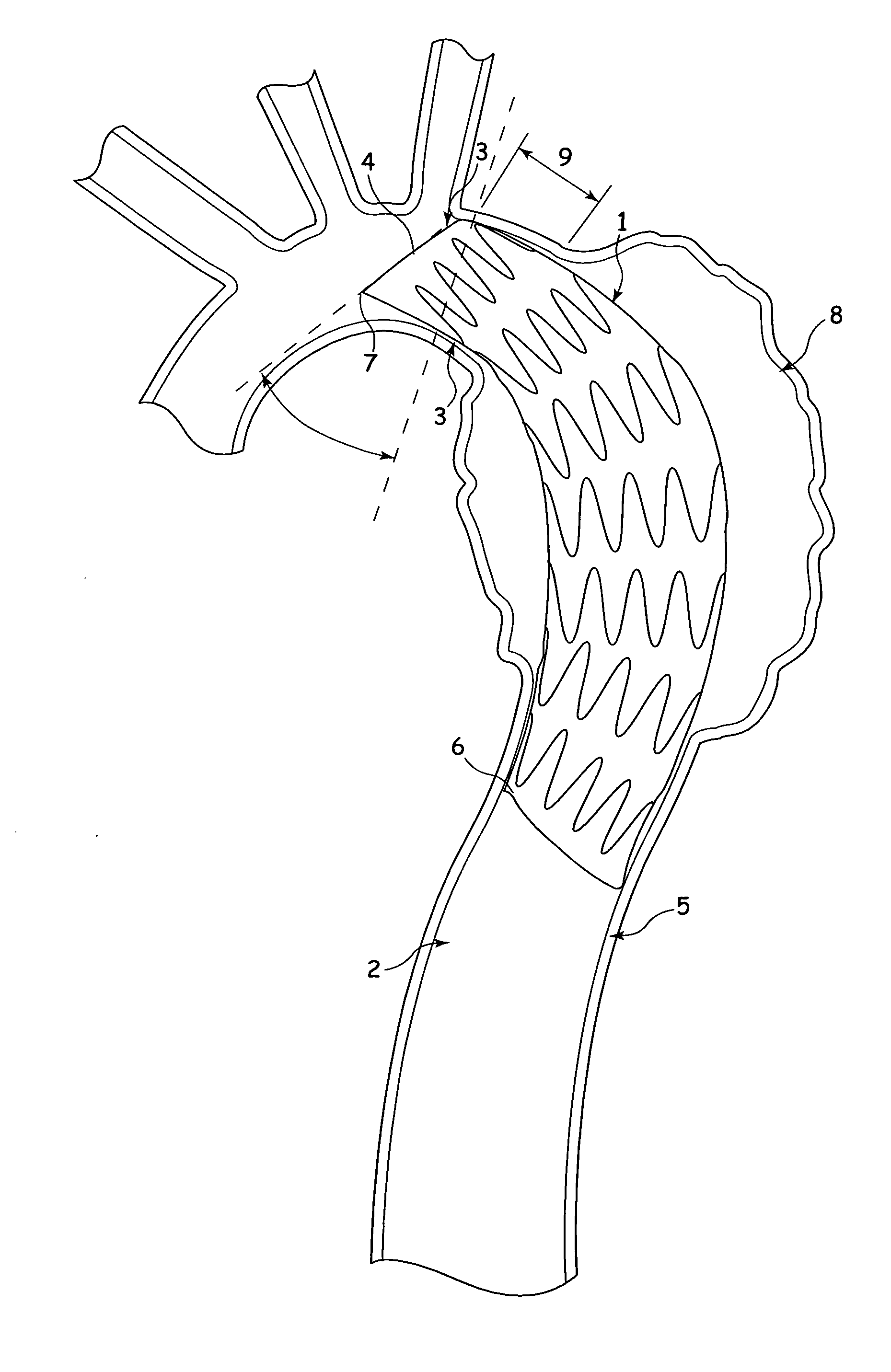 Stent-graft and apparatus and fitting method