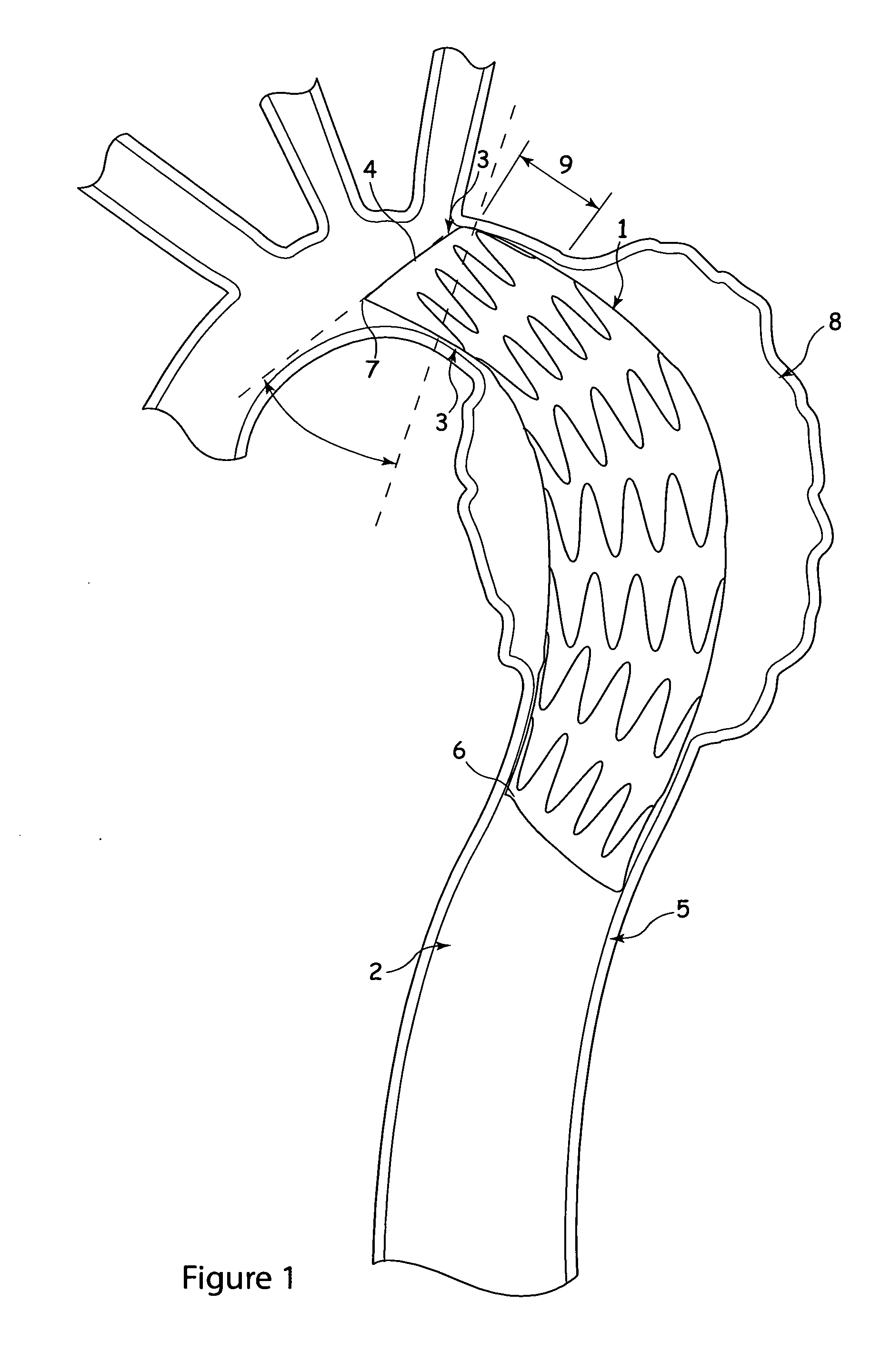 Stent-graft and apparatus and fitting method