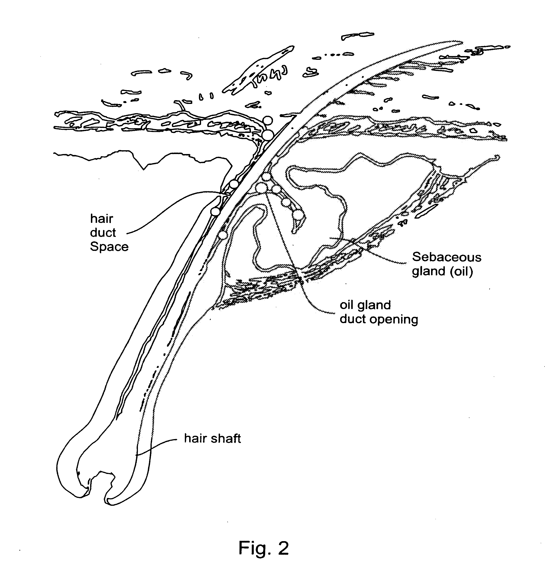 Process for treatment of psoriasis