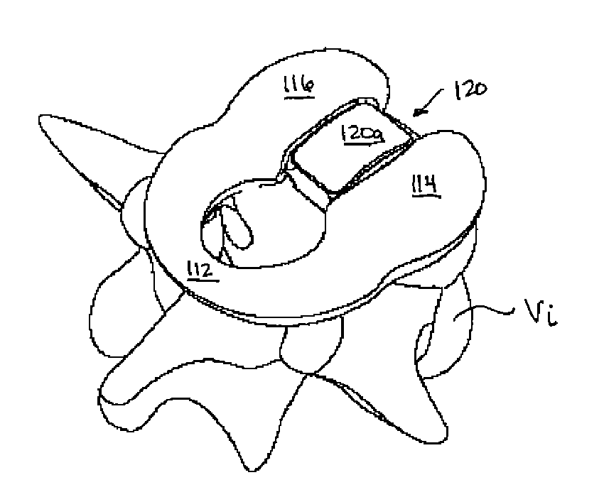 C-shaped disc prosthesis