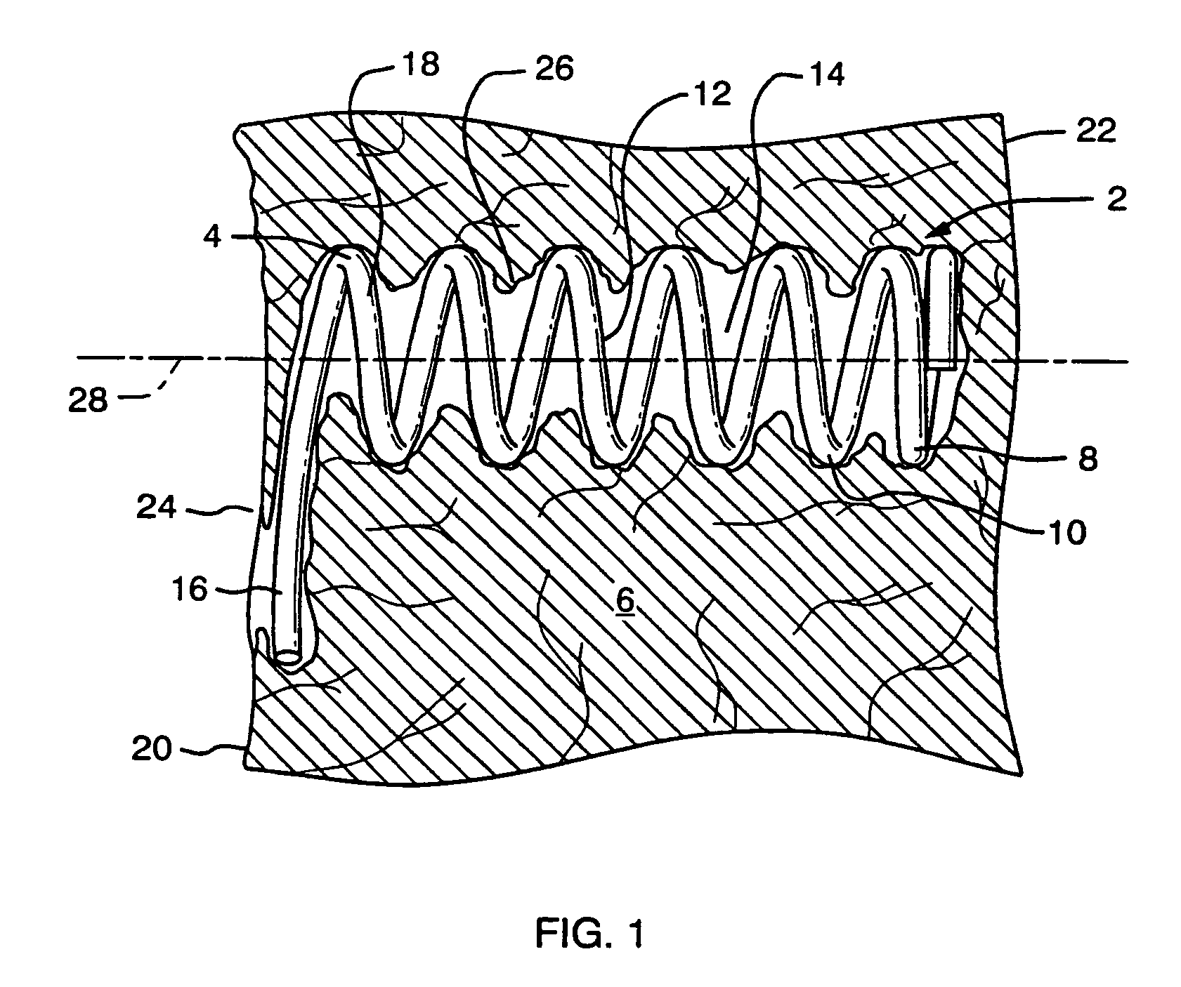 Implant anchor systems