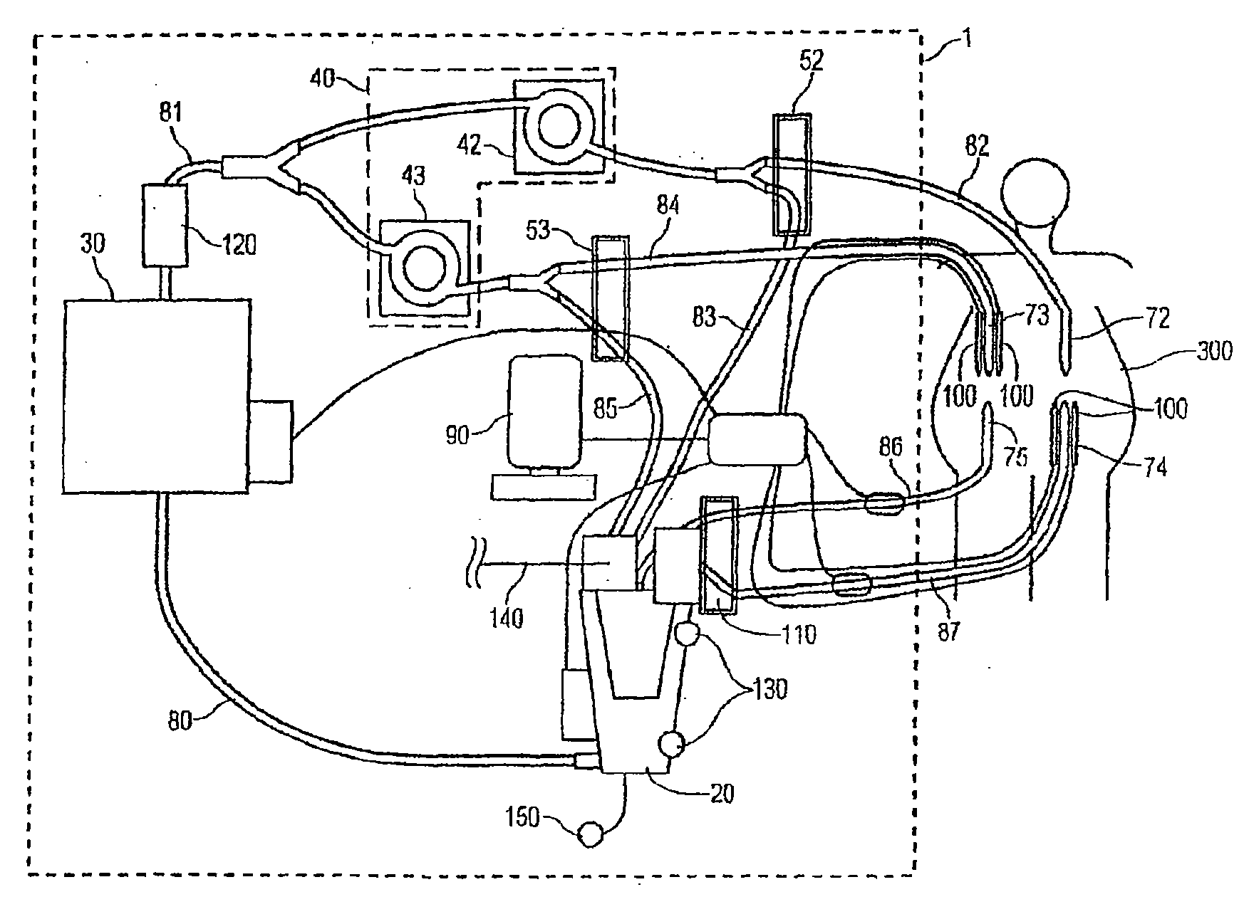 System for chemohyperthermia treatment