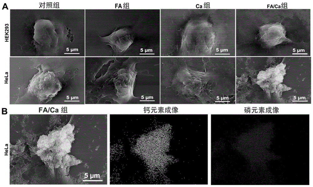 Method for calcification of cancer cells