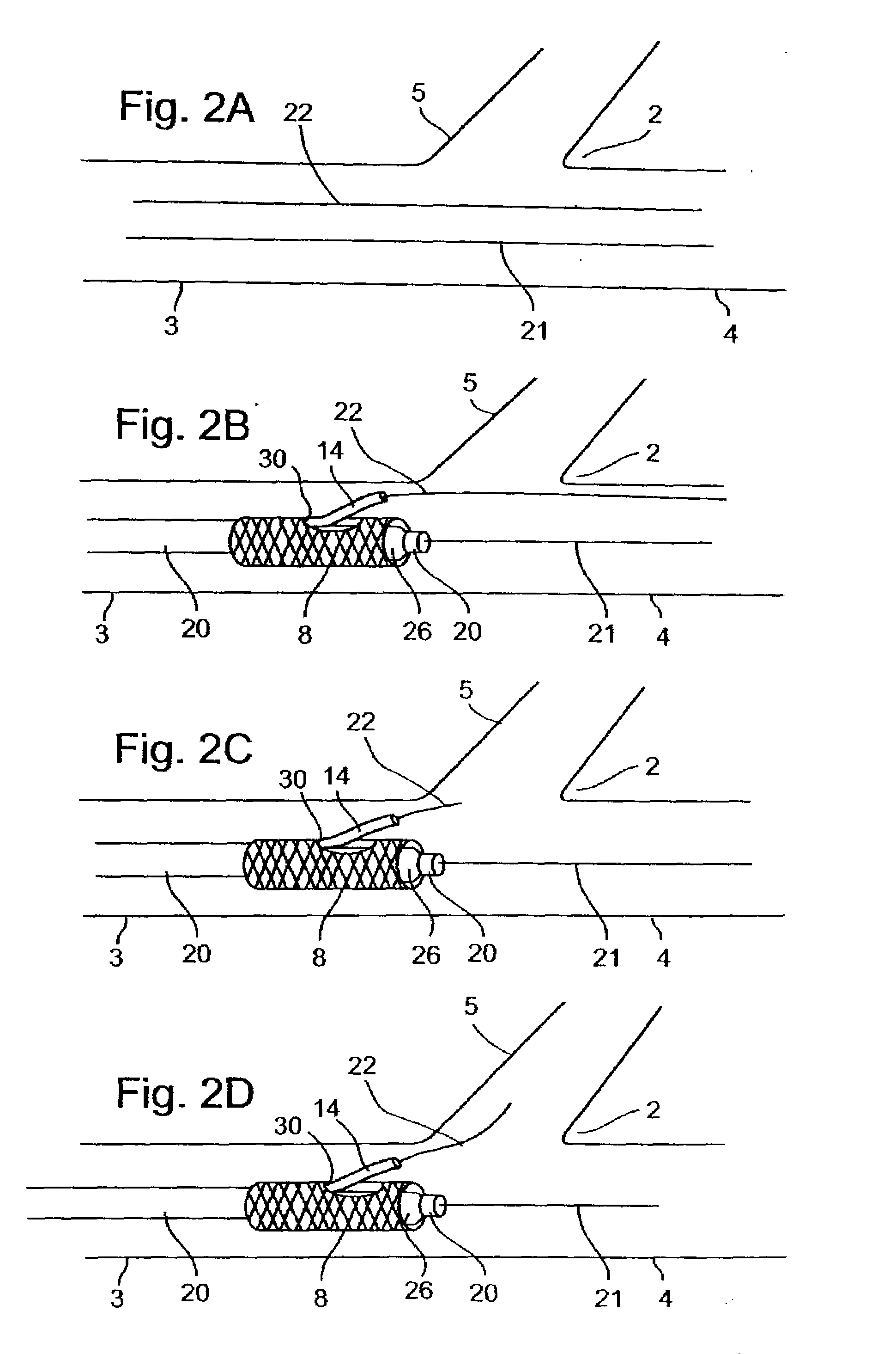 Methods for deploying stents in bifurcations