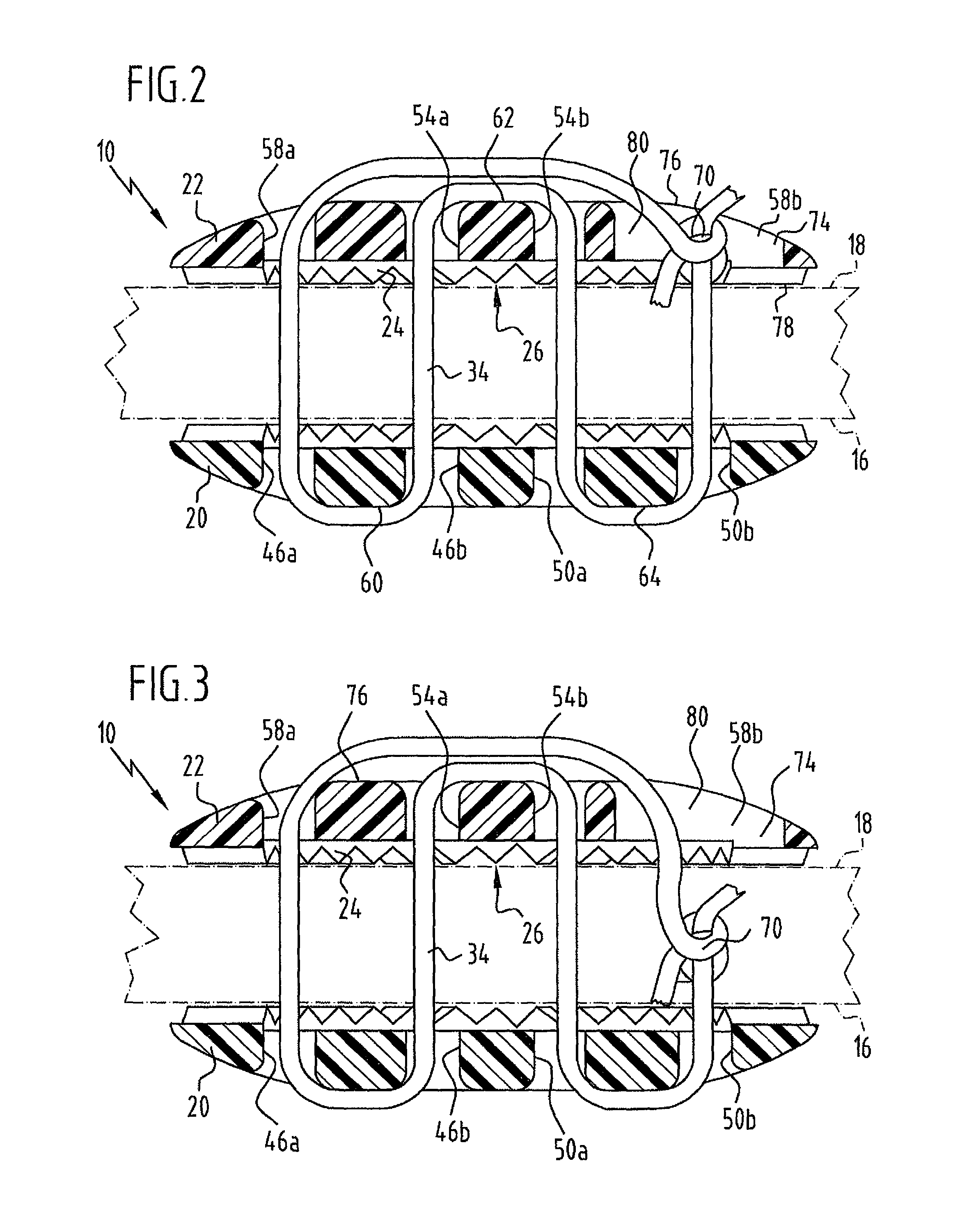 Implant for securing neighboring bone plates