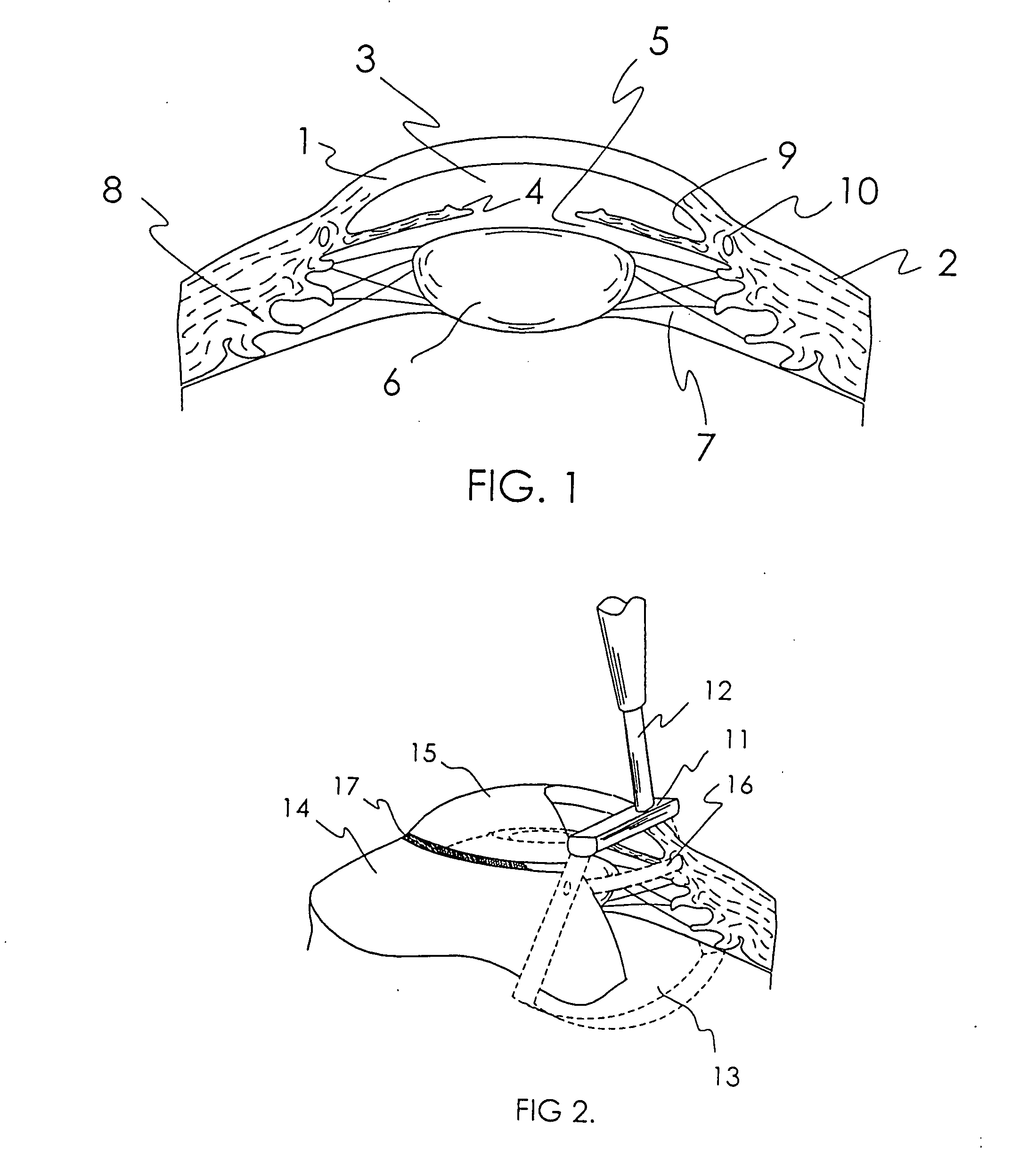 Treatment of ocular disease