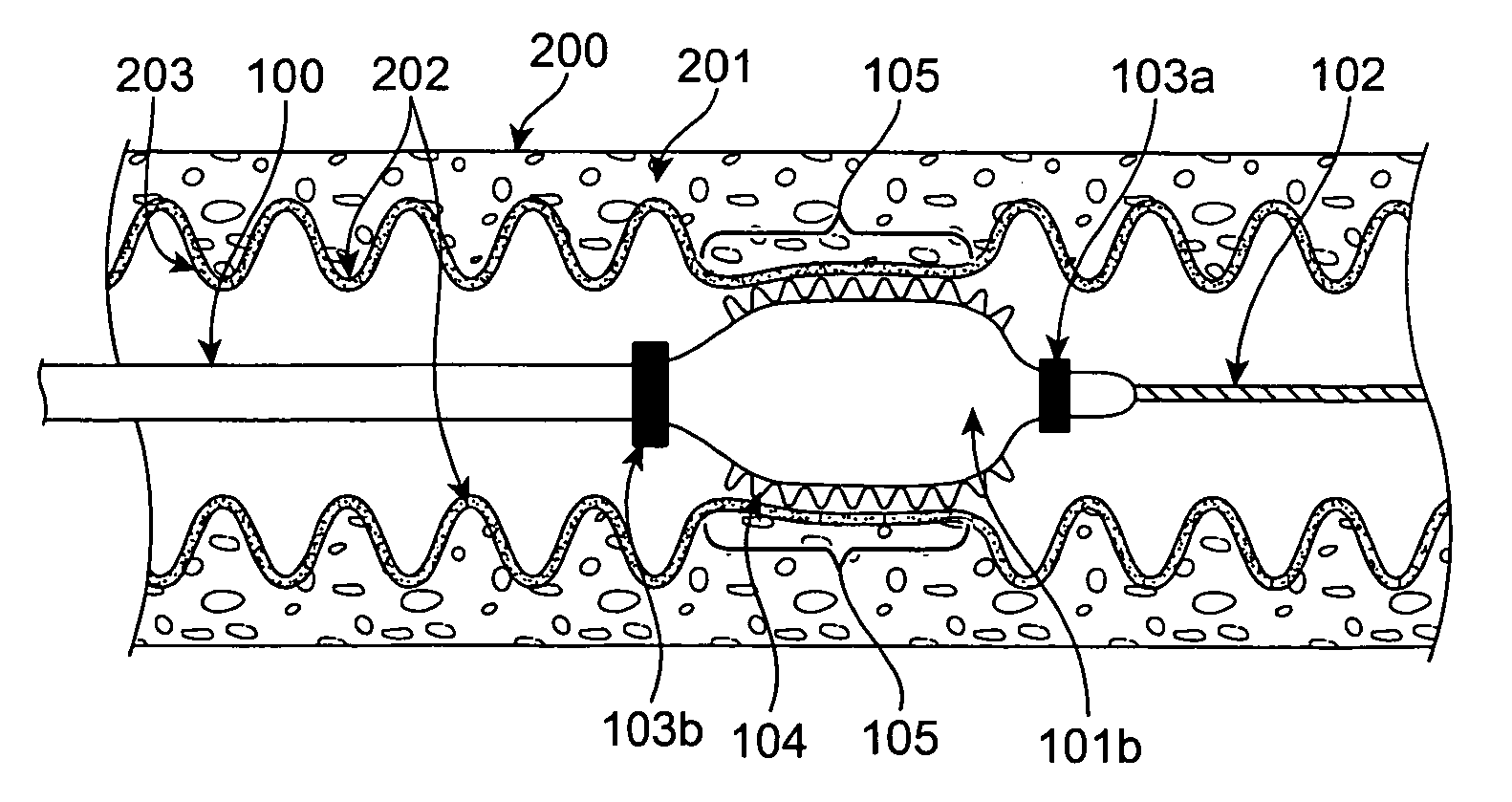 Methods and devices for obesity treatment