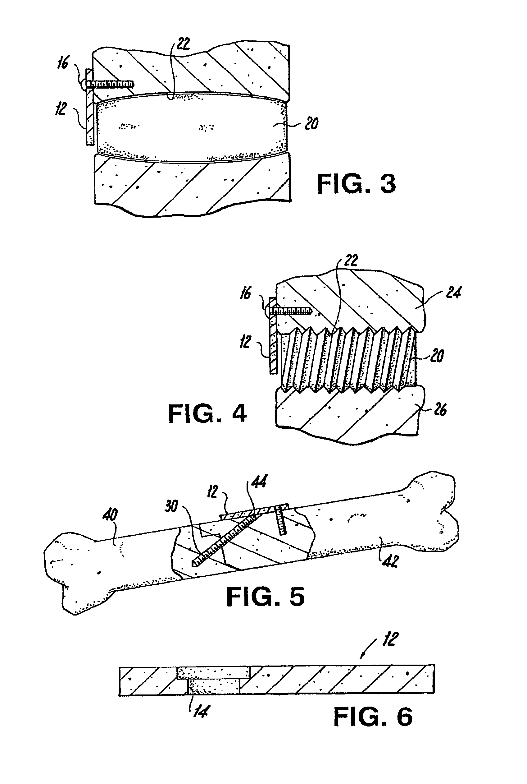 Implant retaining device