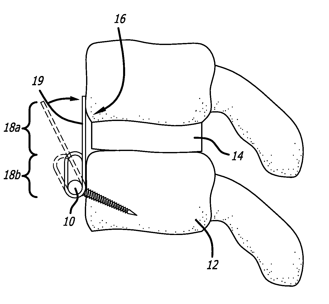 Low profile implant locking plates