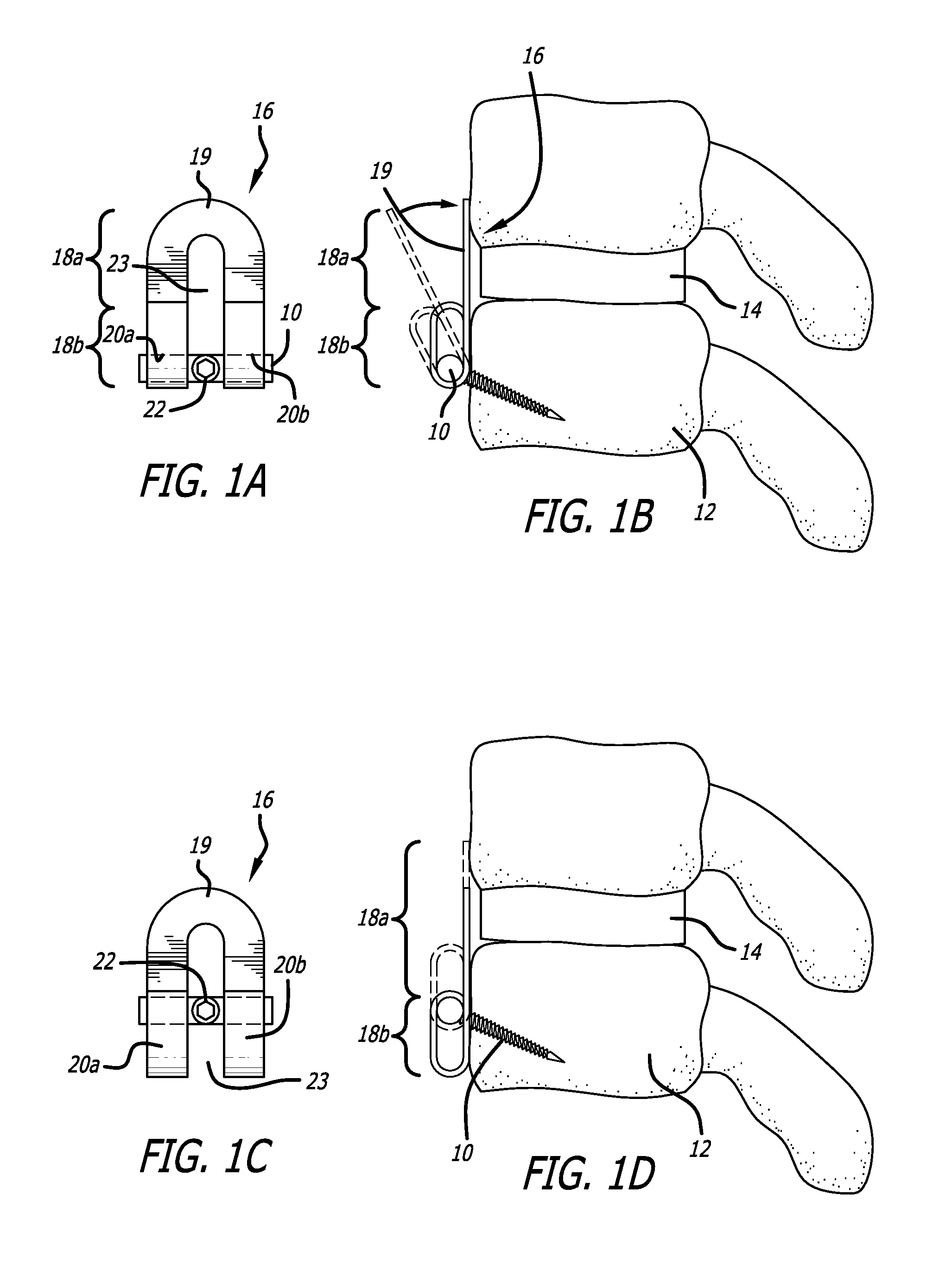 Low profile implant locking plates