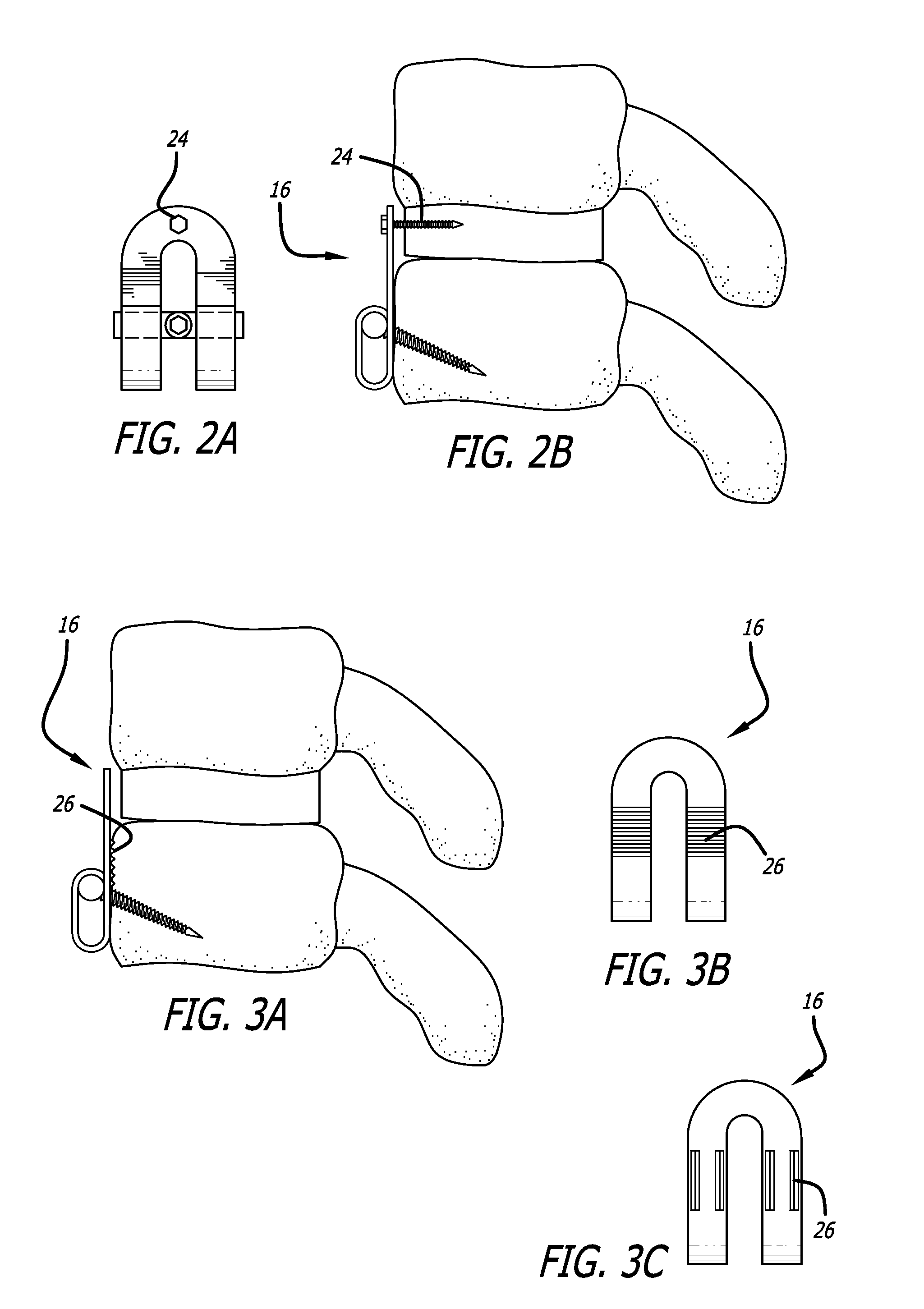 Low profile implant locking plates