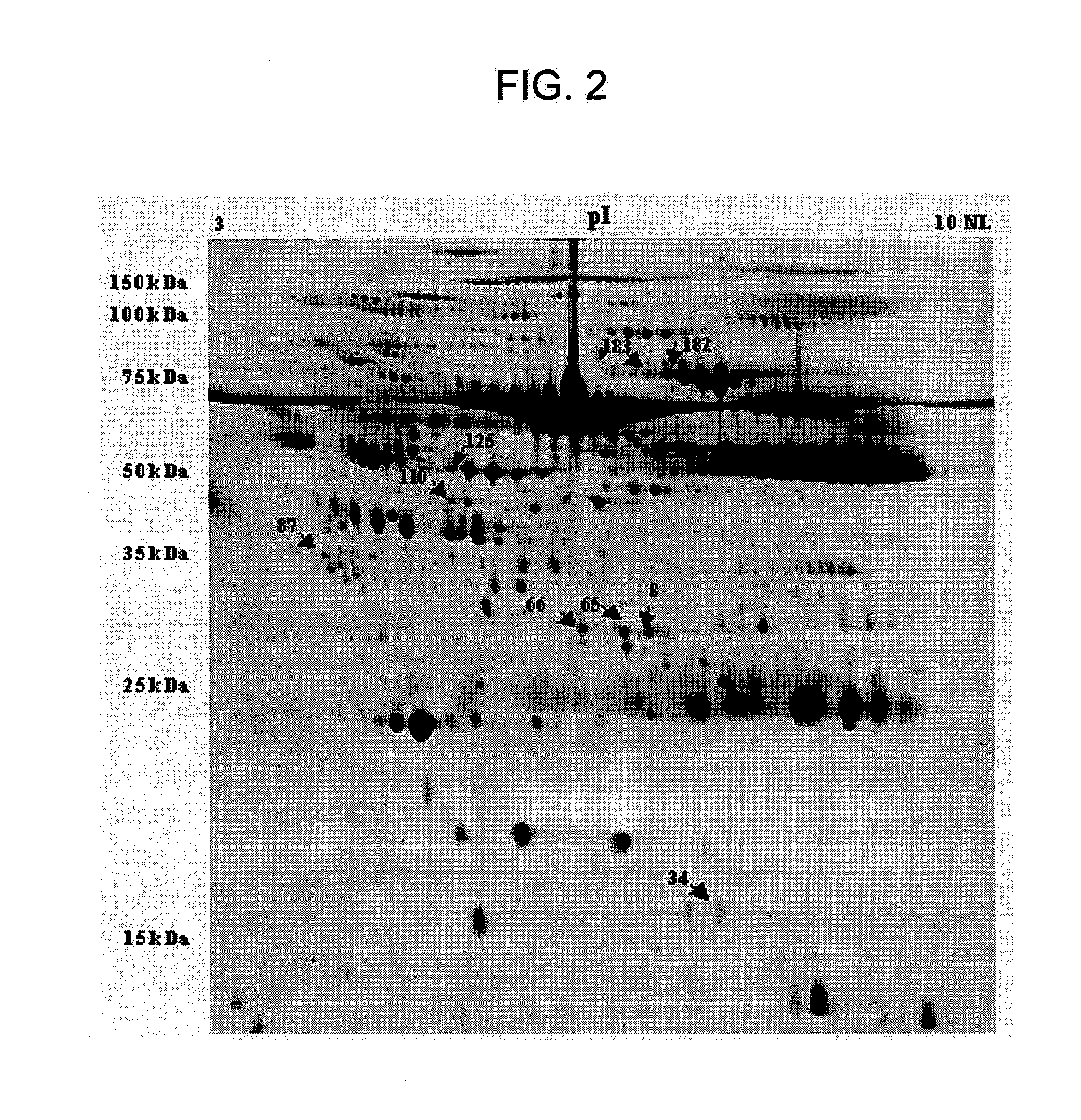 Biomarkers for diagnosing and detecting the progression of neurodegenerative disorders, in particular of amyotrophic lateral sclerosis