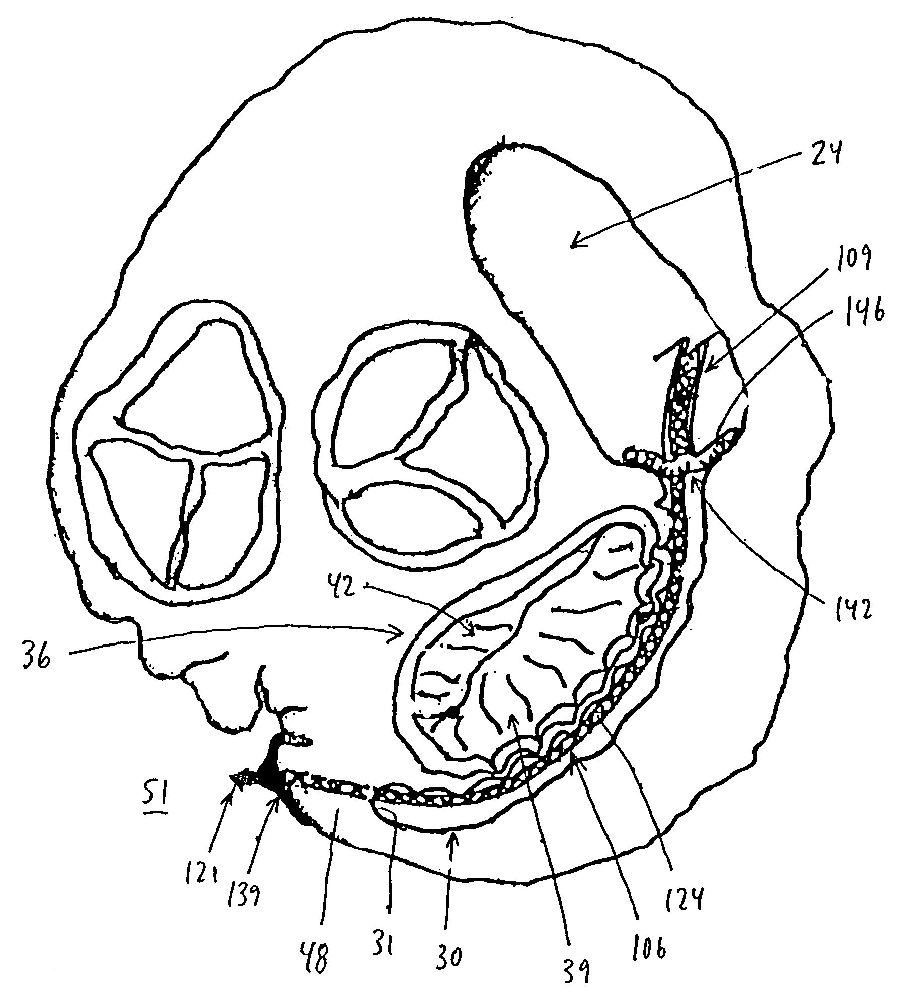 Method and apparatus for reducing mitral regurgitation