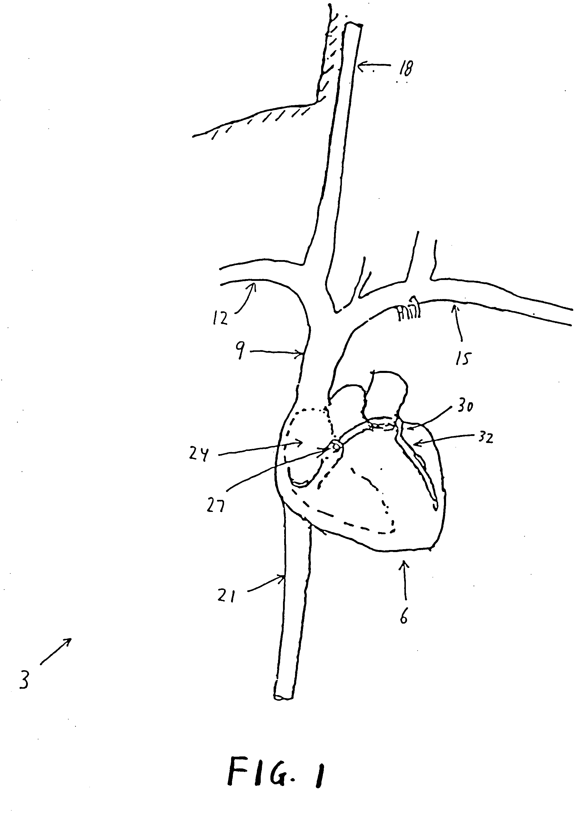 Method and apparatus for reducing mitral regurgitation