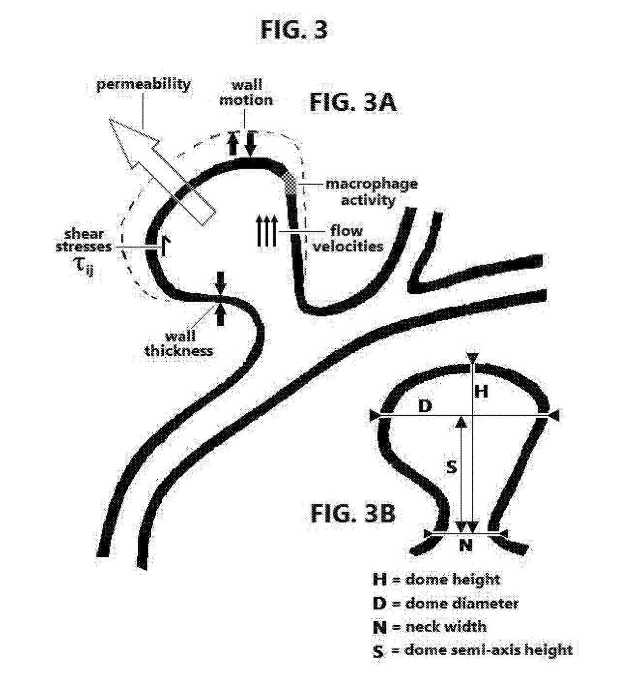 Treatment of unruptured saccular intracranial aneurysms using stereotactic radiosurgery