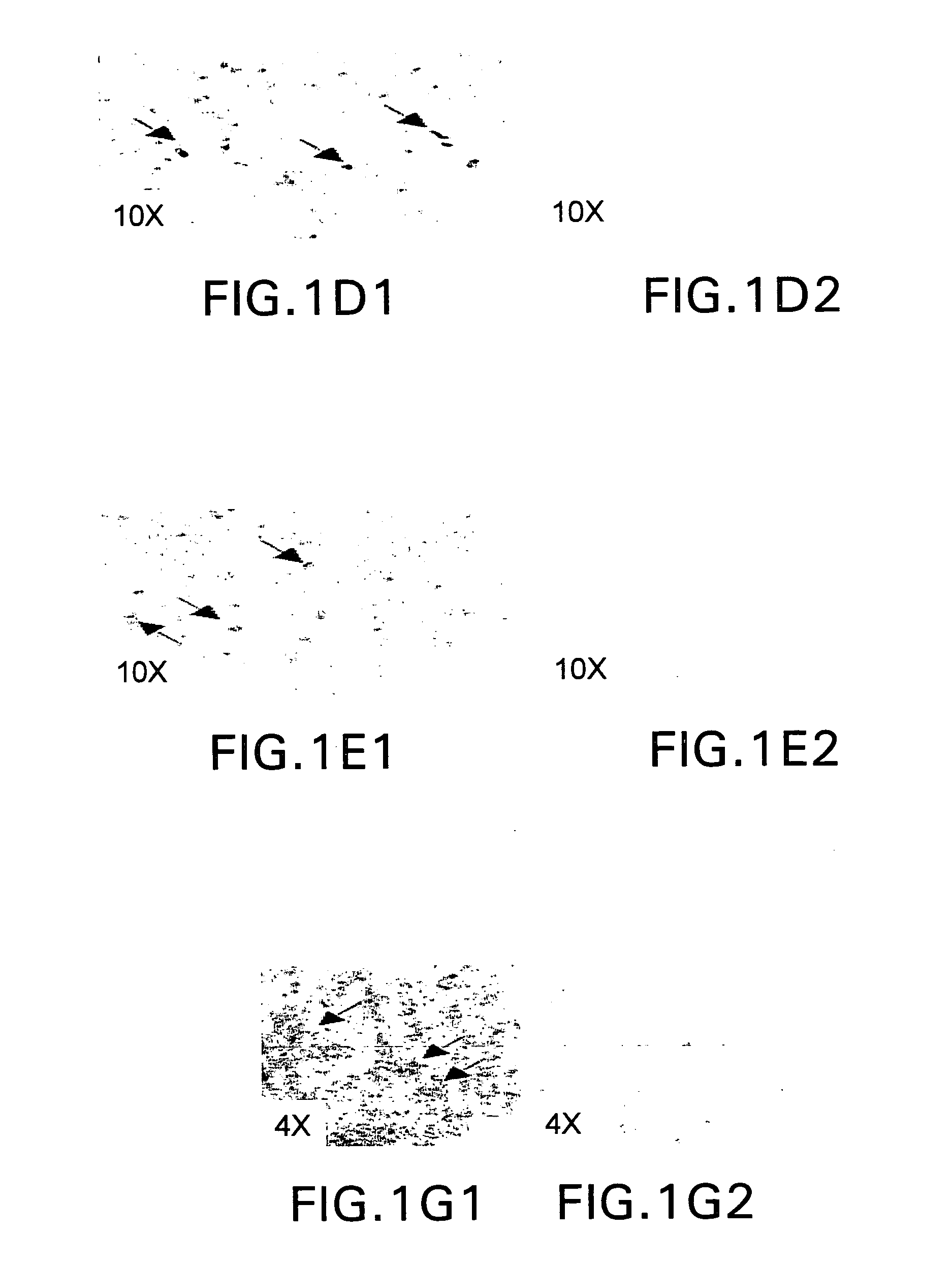 Vectors having both isoforms of beta-hexosaminidase