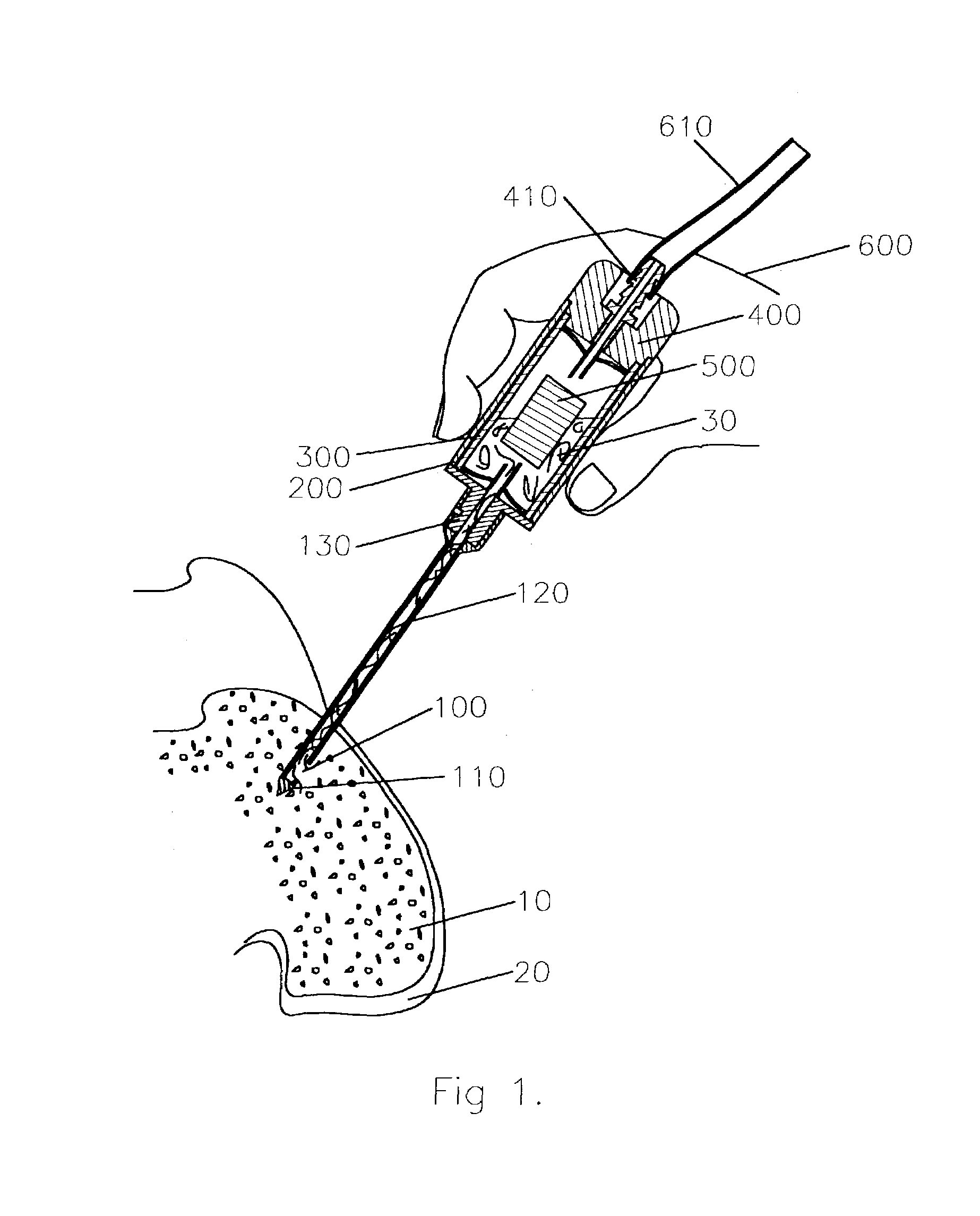 Bone marrow aspiration and biomaterial mixing system